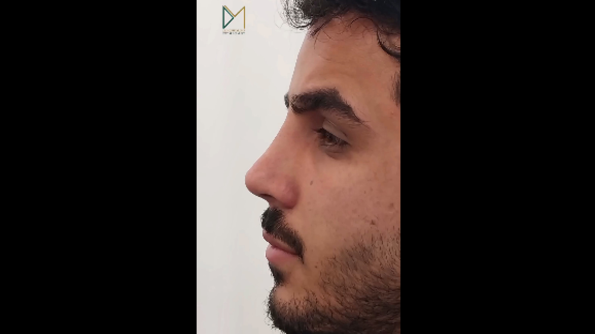 شش ماه پس از جراحی زیبایی بینی دکتر فاطمه مختاری فر جراح بینی در لرستان
