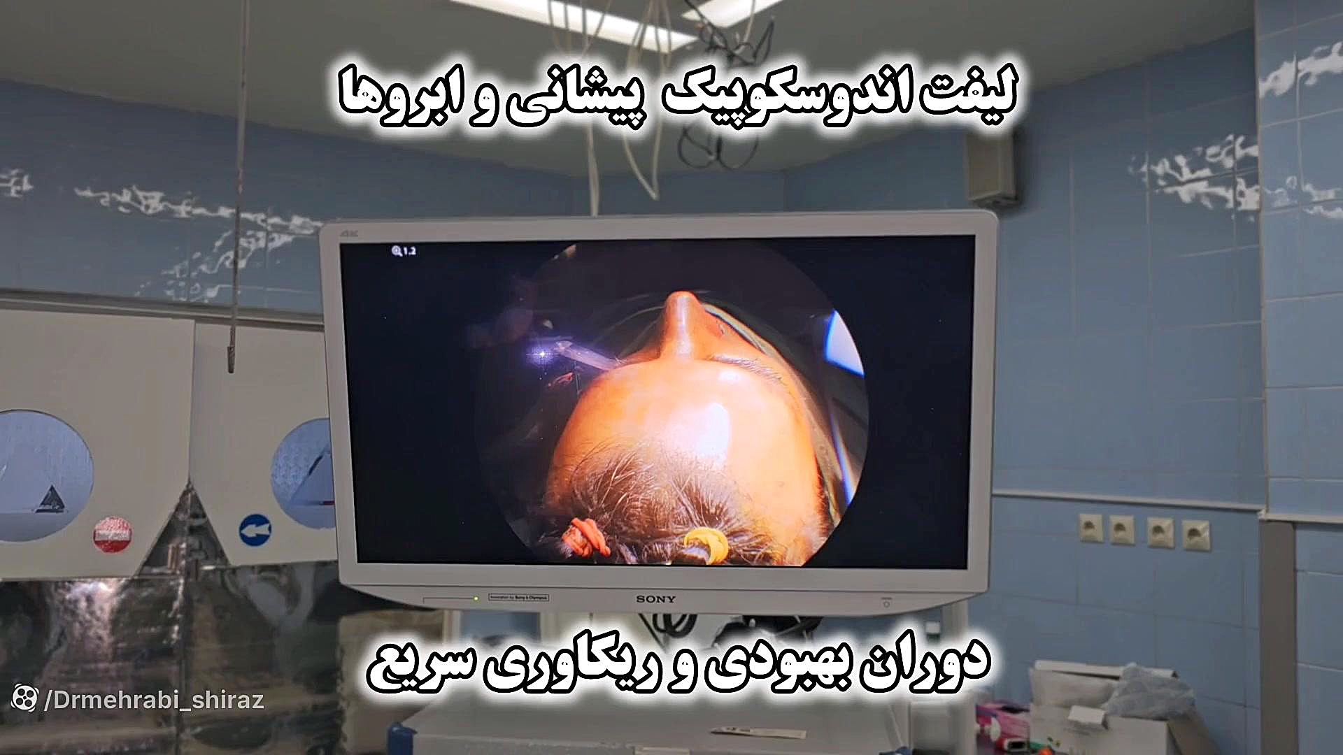 لیفت ابرو لیفت پیشانی اندوسکوپیک در شیراز دکتر مهرابی دکتر محمد مهدی مهرابی جراح پلاستیک و زیبایی