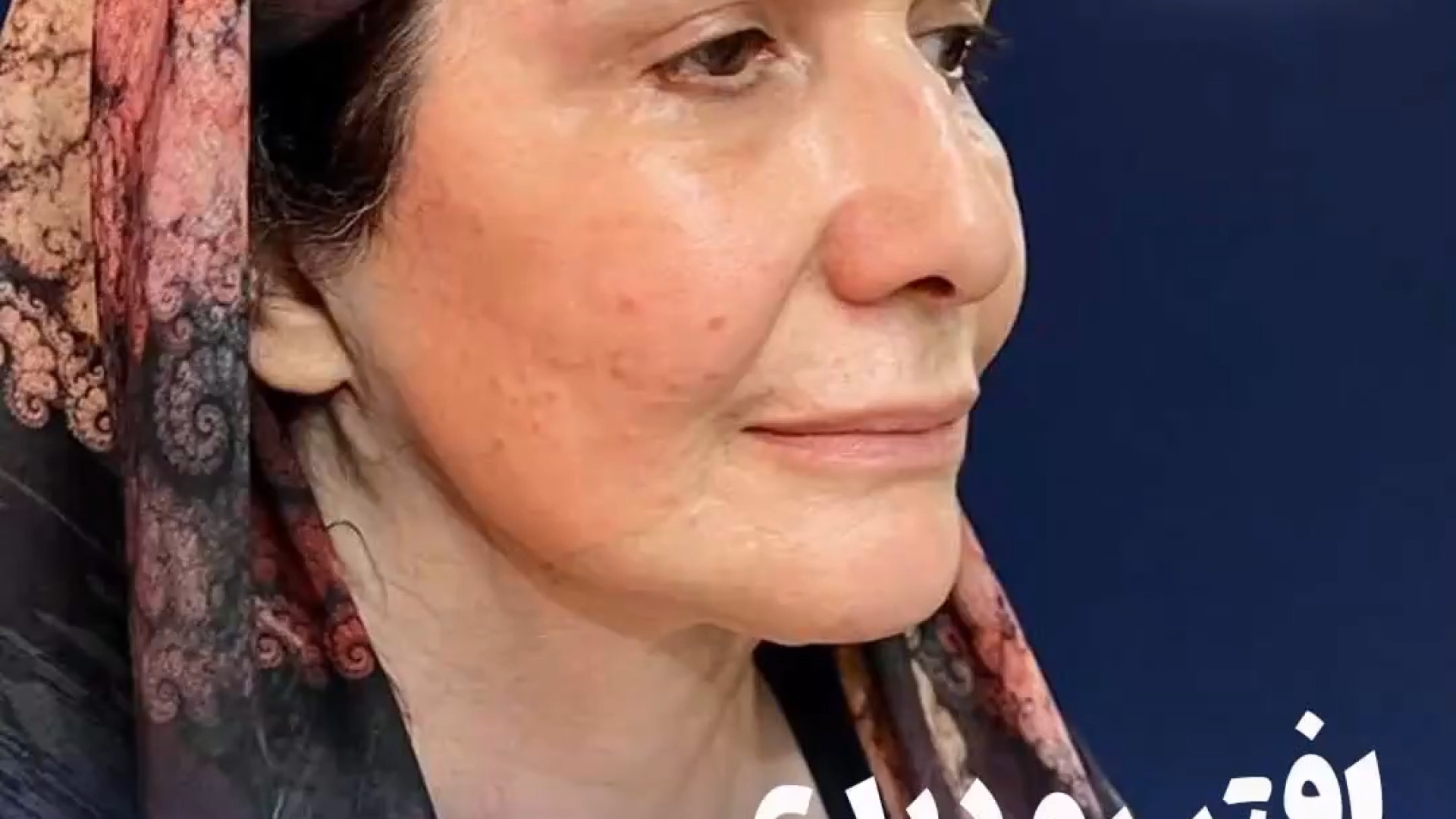لیفت صورت و گردن و جراحی پلک همزمان | دکتر بهزاد خوروش SVR