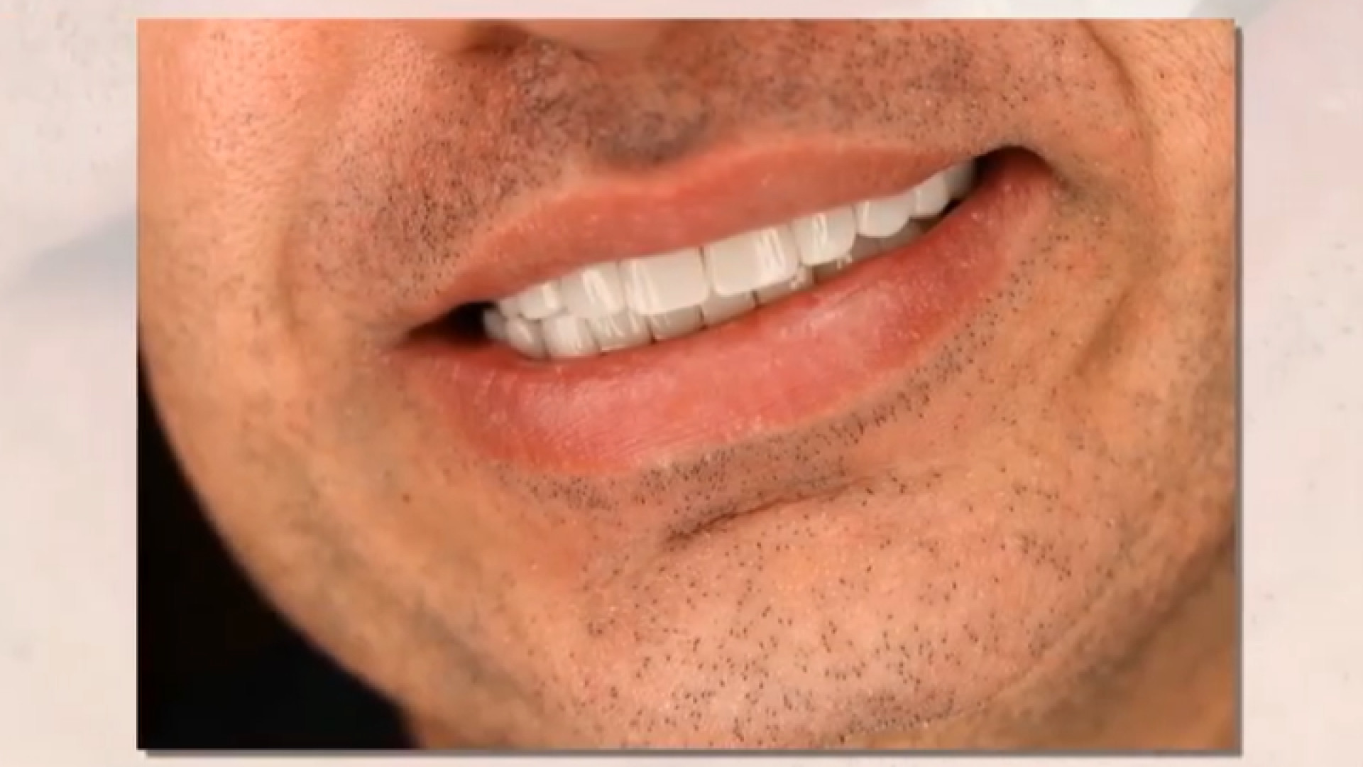 نمونه کار دکتر ندا هادی دکتر ندا هادی-دندانپزشک زیبایی