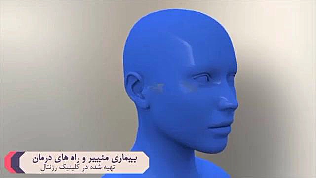 بیماری مینیر یا سرگیجه فشار گوش میانی اصلاح فرم صورت