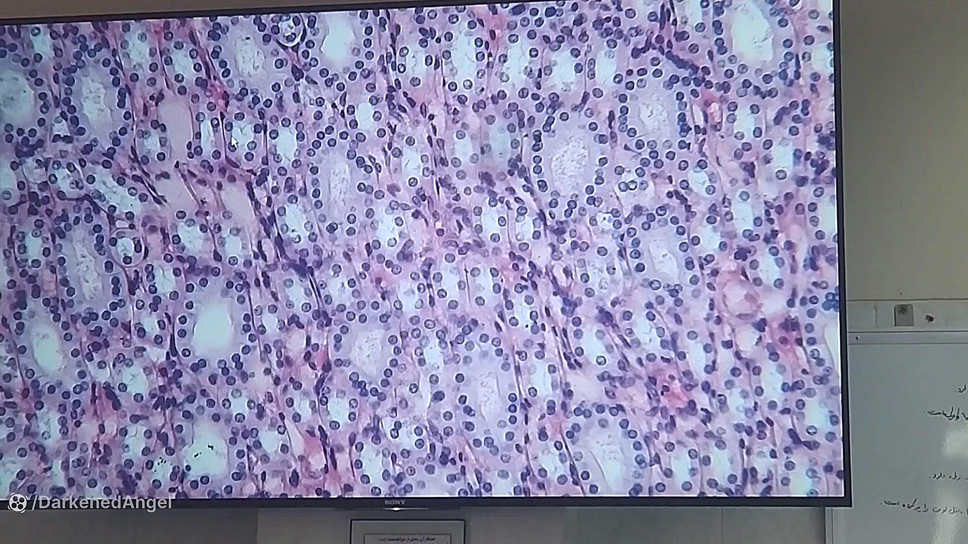 لام کلیه پیلینگ