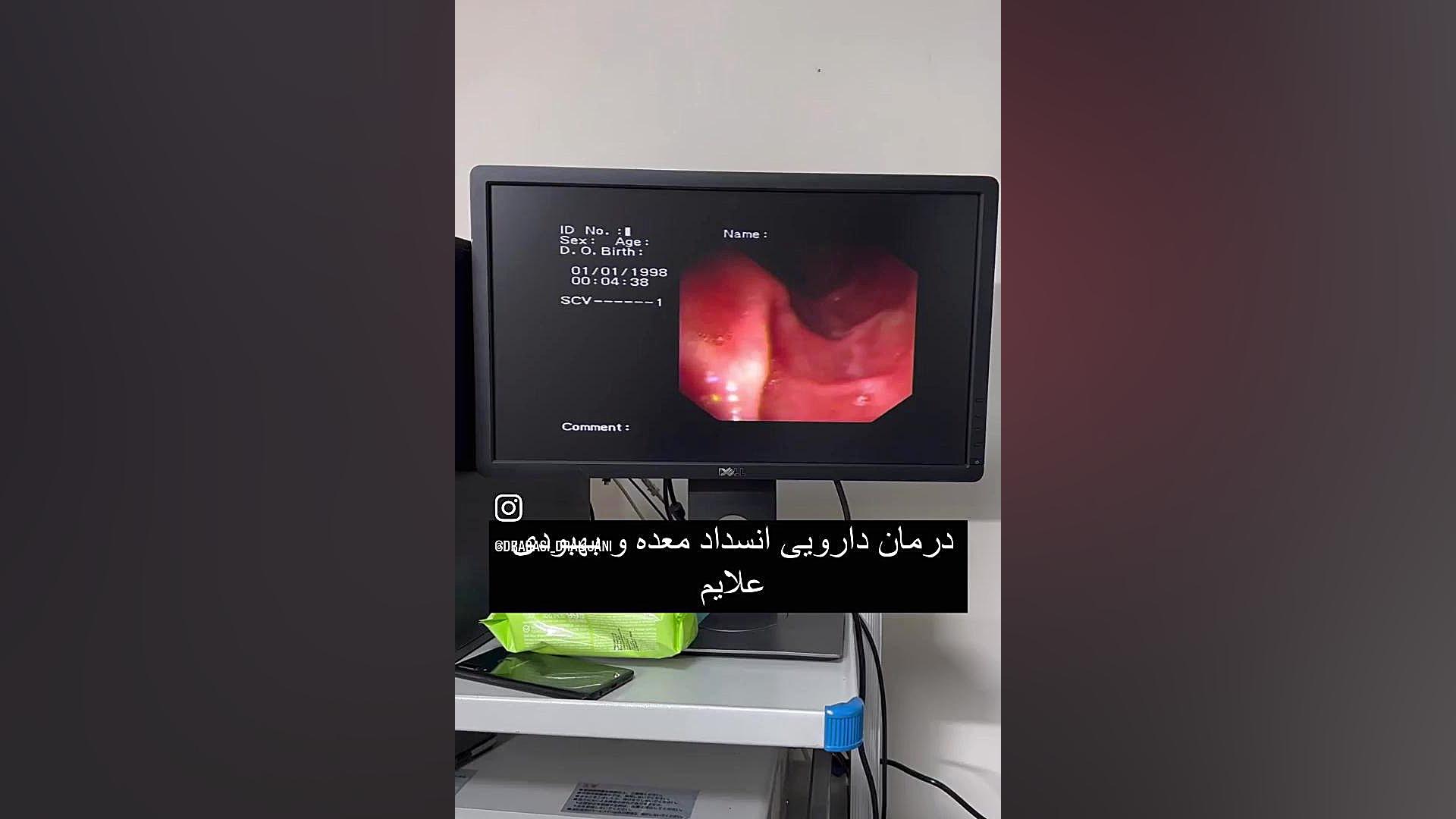 اندوسکوپی انسداد خروجی معده لیزر موهای زائد