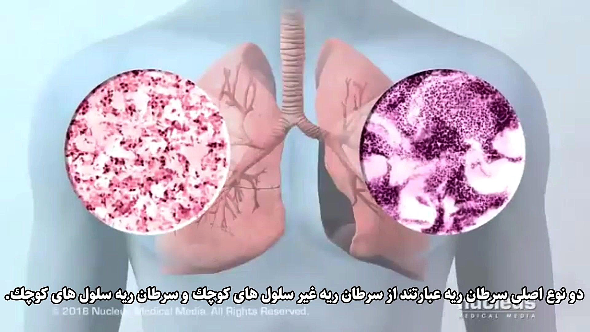 سرطان ریه برداشتن خال گوشتی