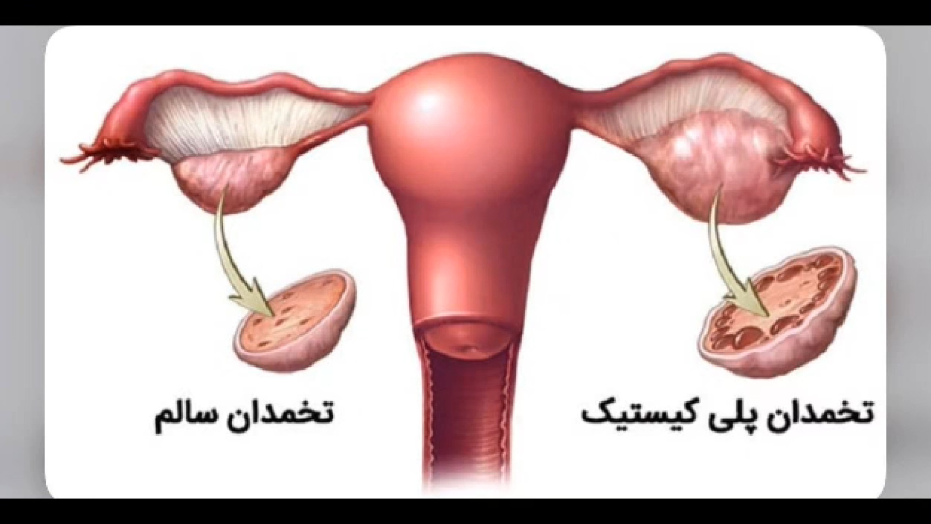 سندرم تخمدان پلی کیستیک ترمیم لبخند لثه‌ای