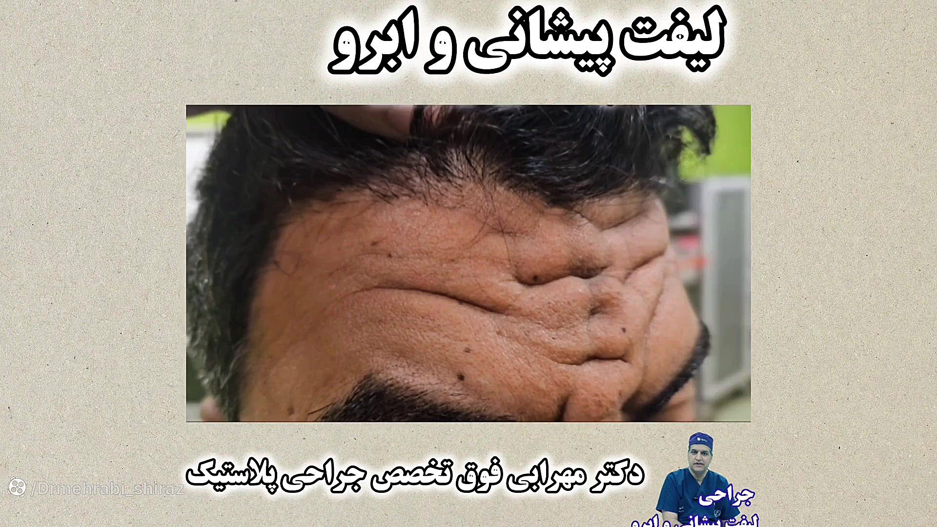 لیفت ابرو لیفت پیشانی در شیراز لیفت صورت لیفتینگ دکتر مهرابی بیولوژی پرتوی