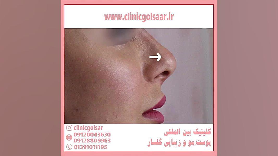 بهترین سن برای انجام لیفت بینی با نخ بررسی لک صورت
