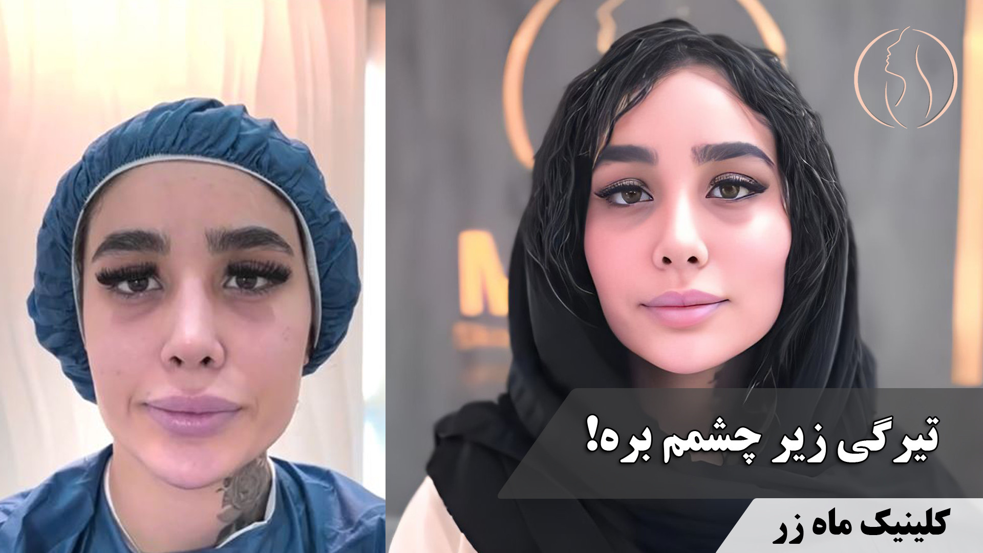 تیرگی زیر چشمت زیاده،اینو بخون ( کلینیک زیبایی ماه زر ) FVC