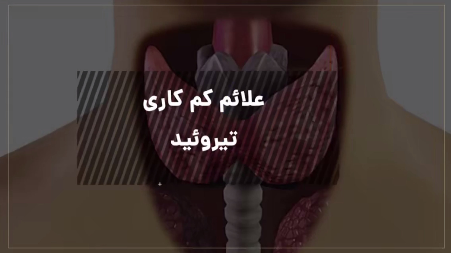کم کاری تیروئید برداشتن خال گوشتی