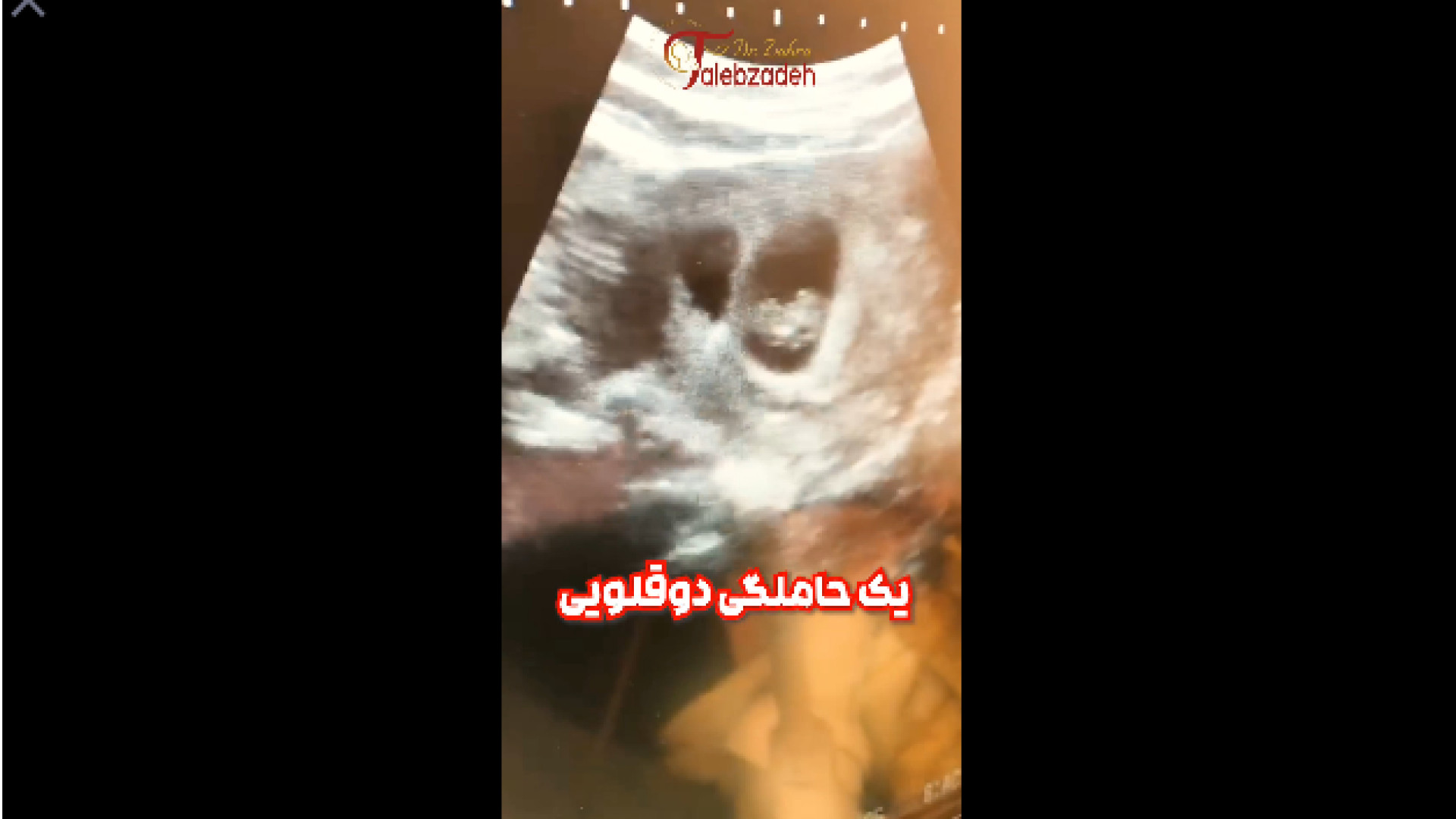 بارداری بعد از 5 سال دکتر زهرا طالب زاده