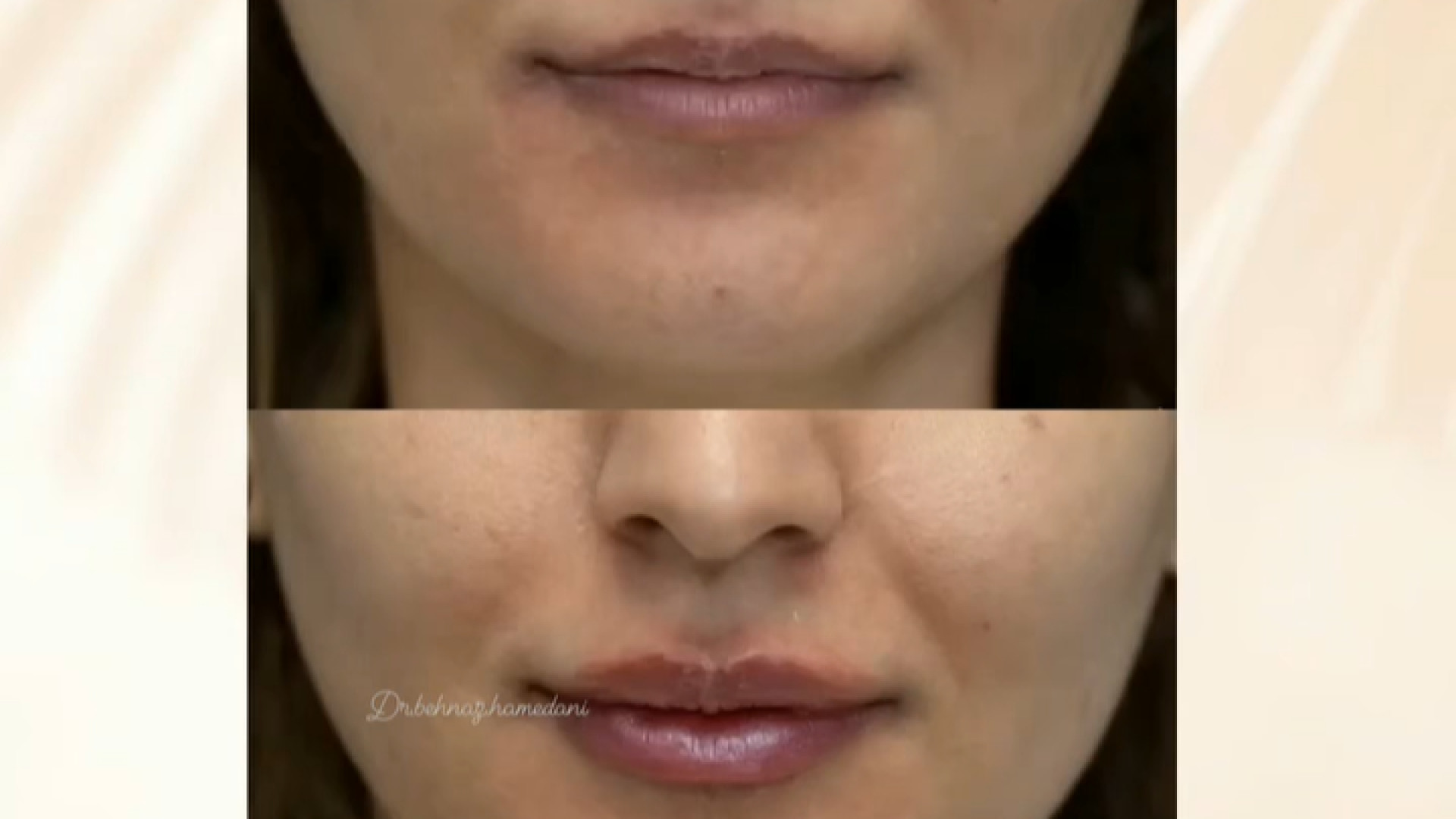 فیلم تزریق فیلر لب دکتر بهناز همدانی - متخصص پوست، مو و زیبایی