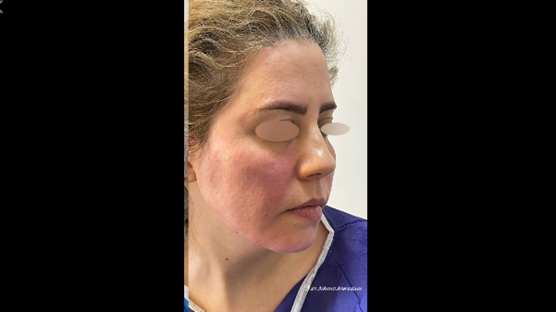 تزریق چربی به صورت دکتر بهناز همدانی - متخصص پوست، مو و زیبایی