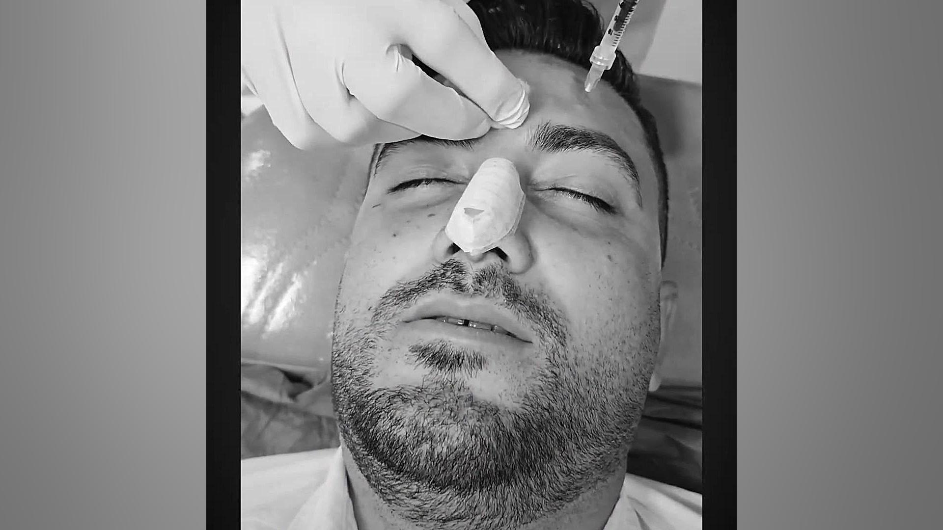 تزریق بوتاکس پیشانی | دکتر علی حسینی واجاری دکتر علی حسینی واجاری - جراح بینی رشت