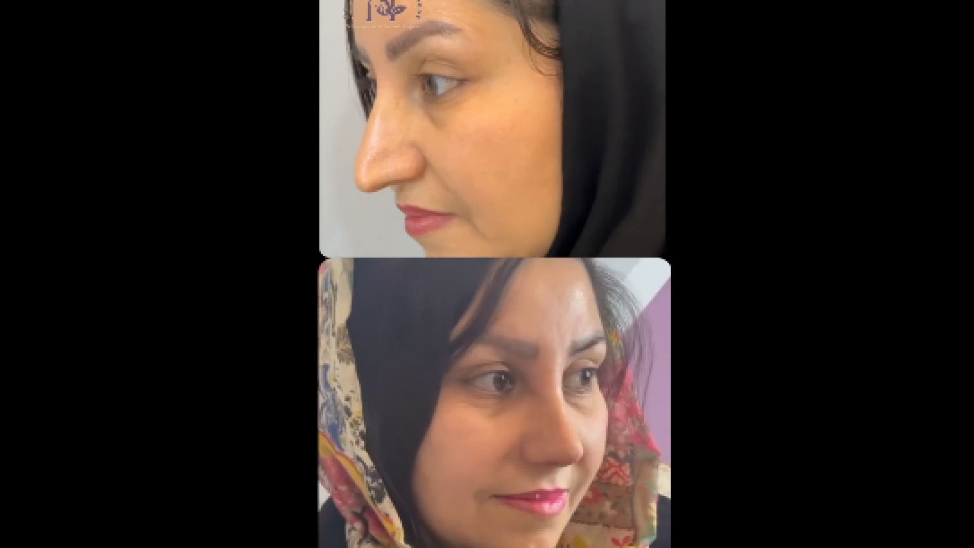 جراحی بینی نچرال استتیک دکتر معصومه حسین پور