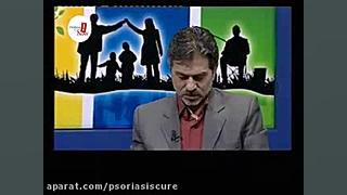مصرف بتامتازون در بیماری پوستی پسوریازیس لولوی بیابون