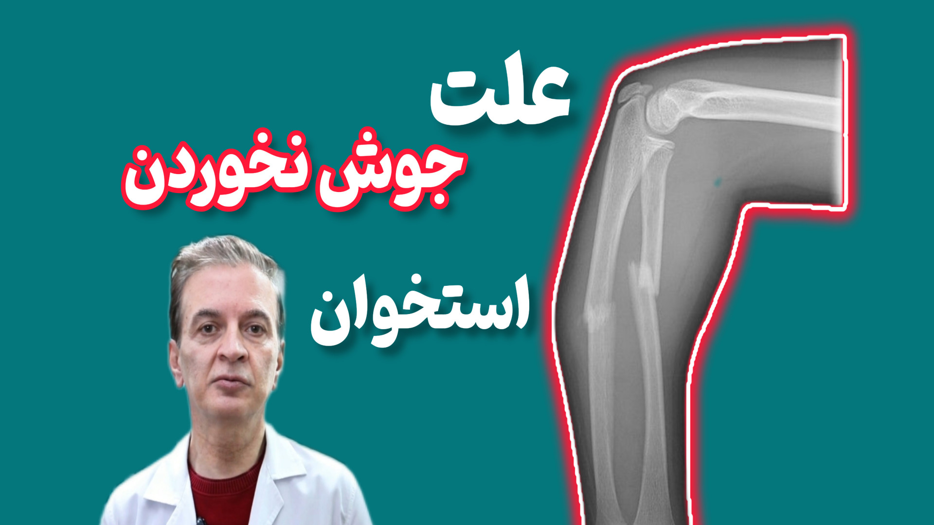 علت جوش نخوردن استخوان دکتر محمود جعفر بیگلو