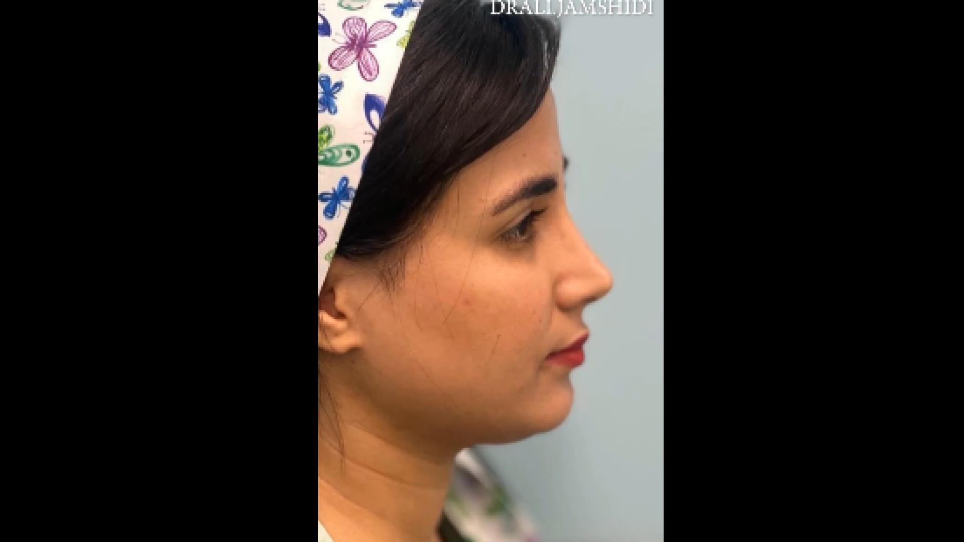 نتیجه رینوپلاستی دکتر علی جمشیدی