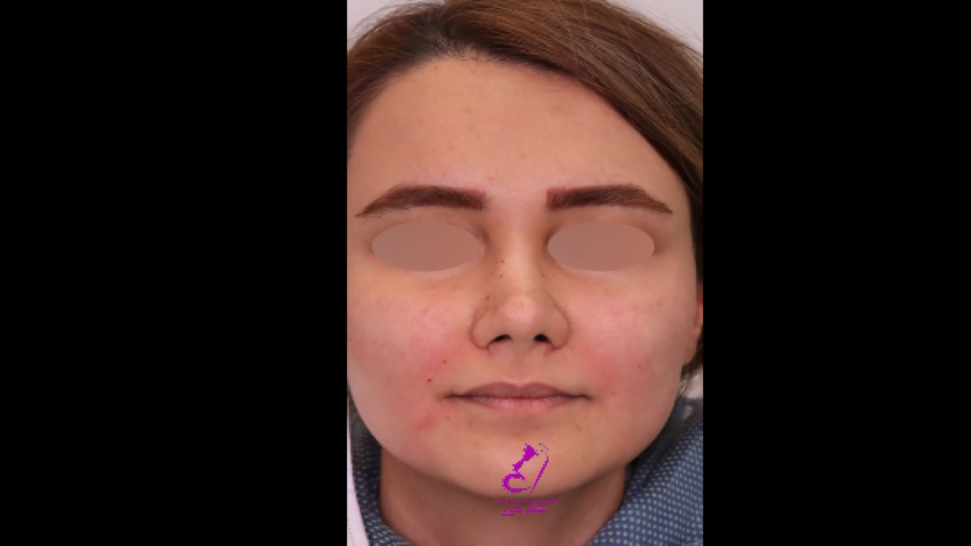 لیفت نخ، فیلر خط خنده و تزریق چربی دکتر هدی عین اللهی