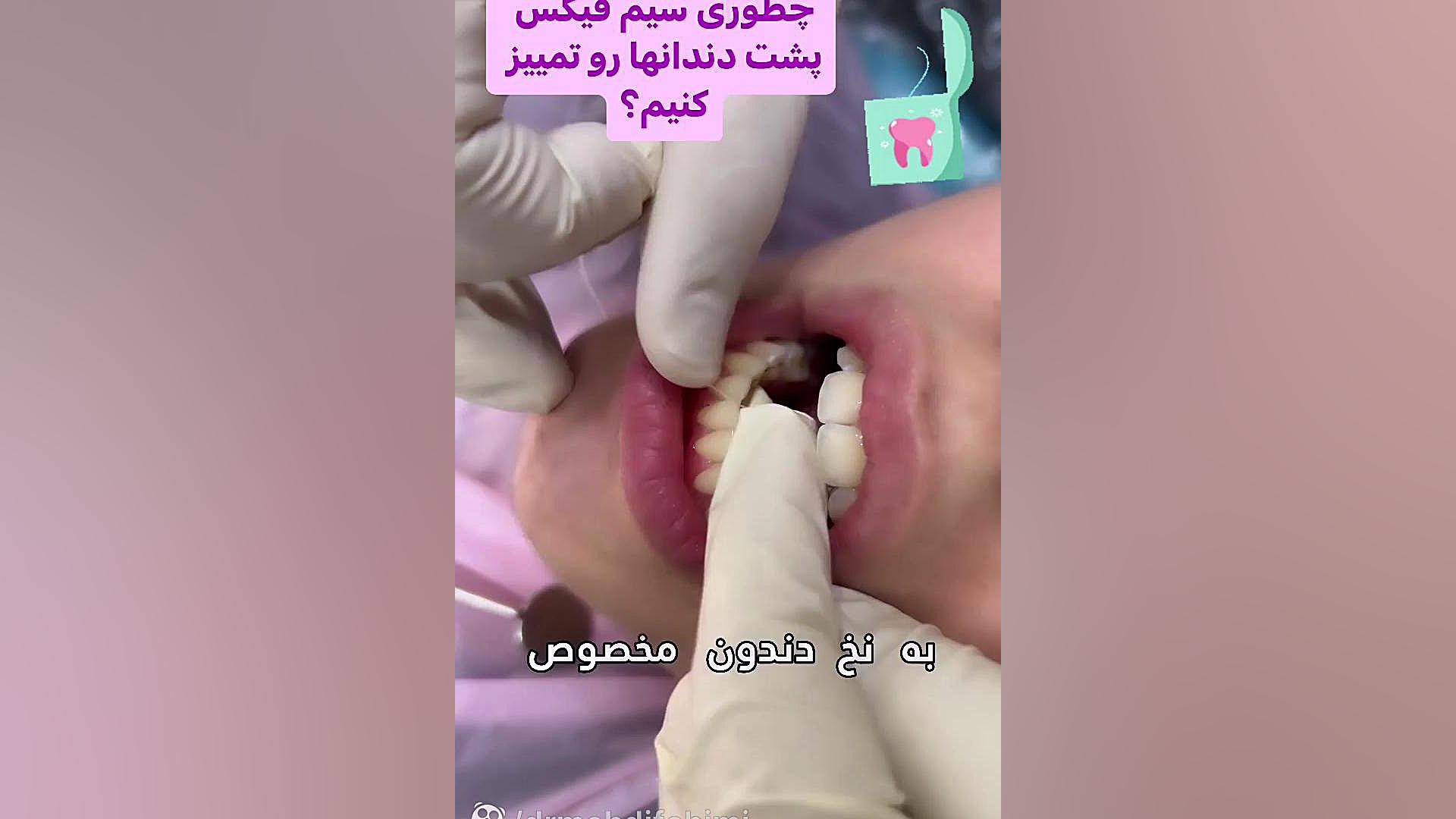 نخ دندان کشیدن سیم فیکس دكتر مهدي فهيمي هنزائي