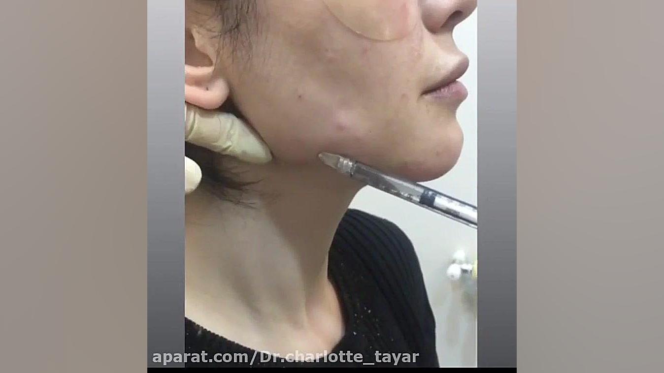 زاویه سازی صورت با تزریق ژل کلینیک دندانپزشکیایمونولوژی پیوند
