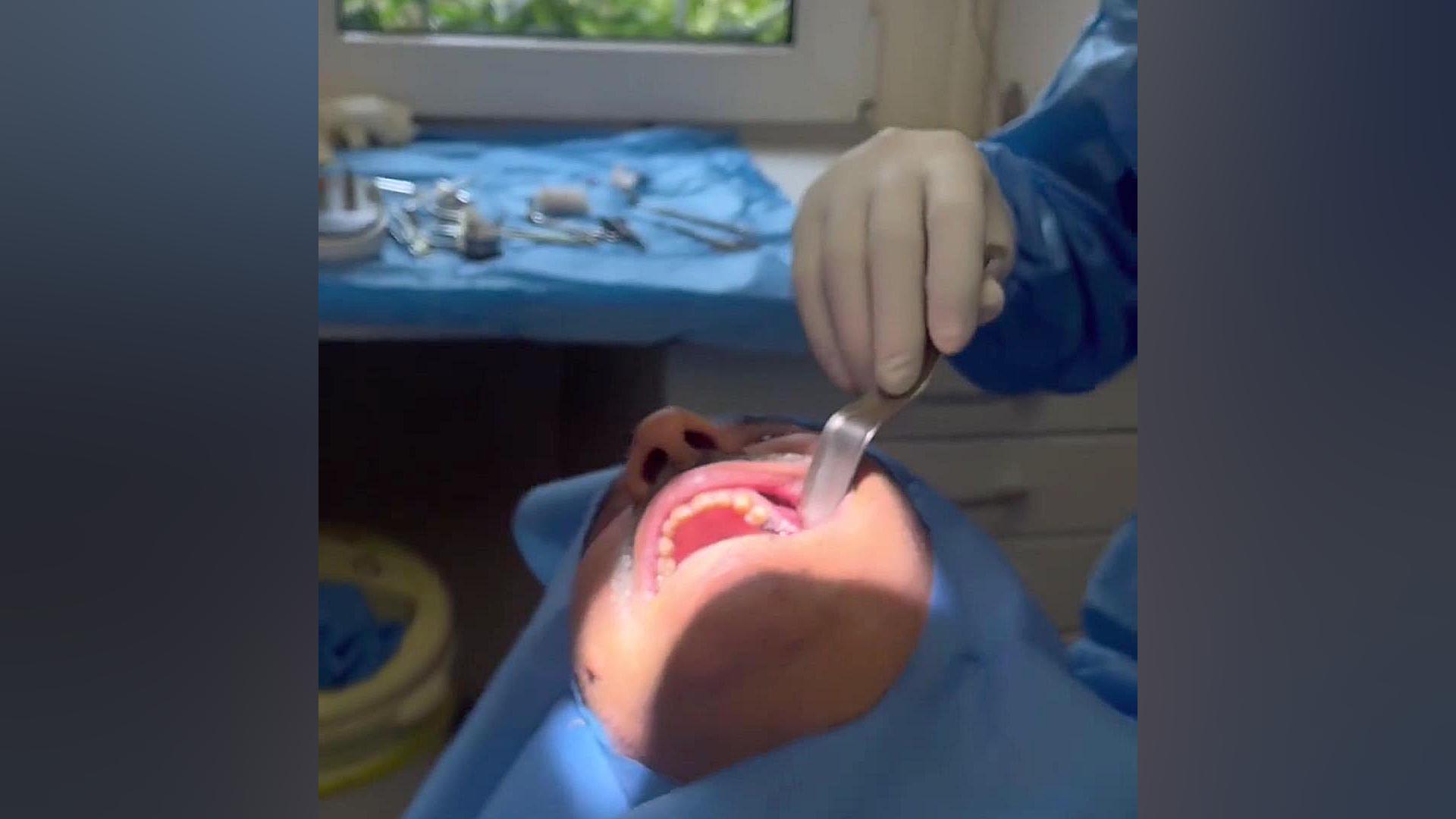 کشیدن دندان و کاشت ایمپلنت همزمان Fluorescence Lifetime Imaging