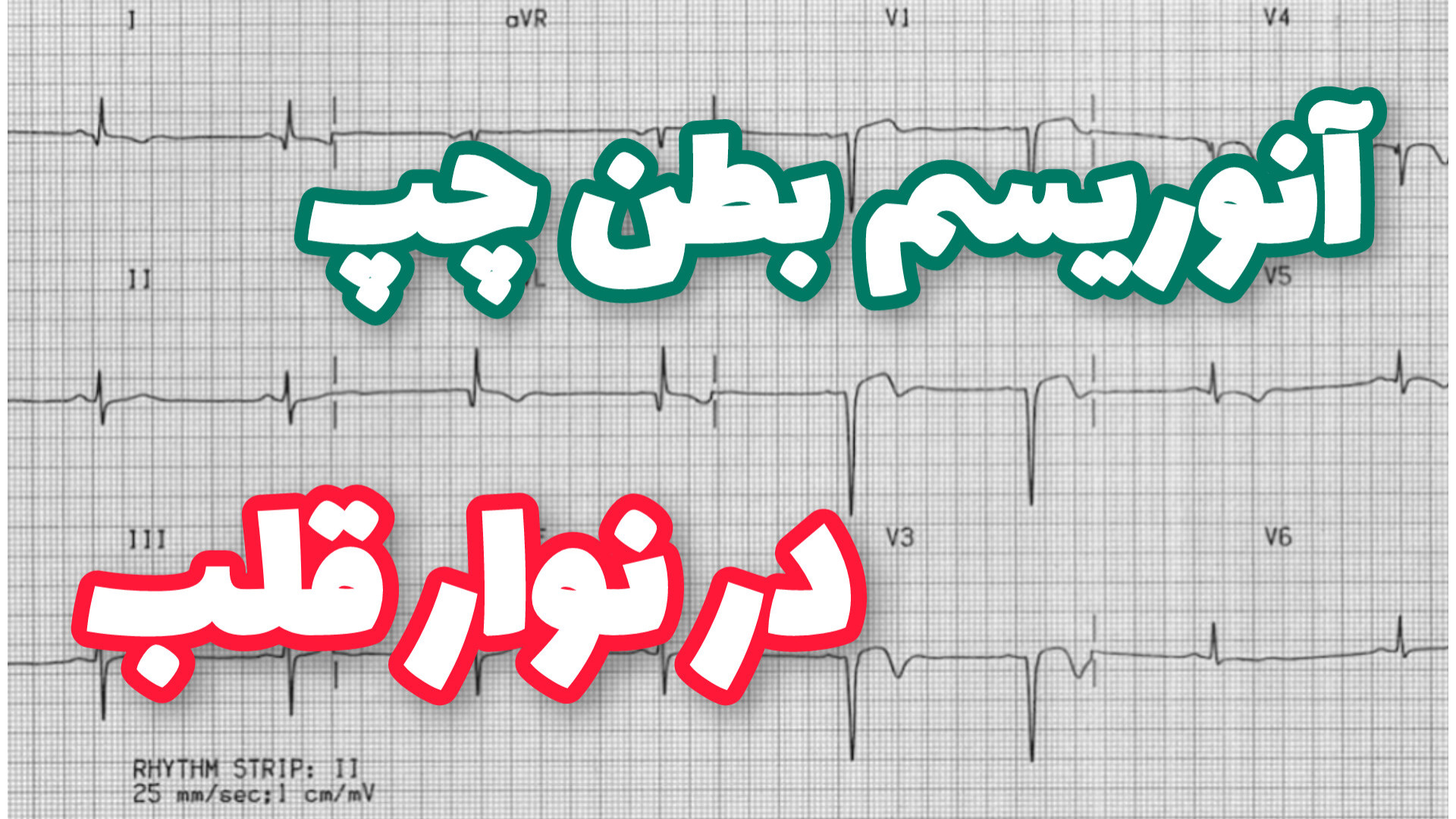 انوریسم بطن چپ در نوار قلب LV Aneurysm in ECG لیفت صورت