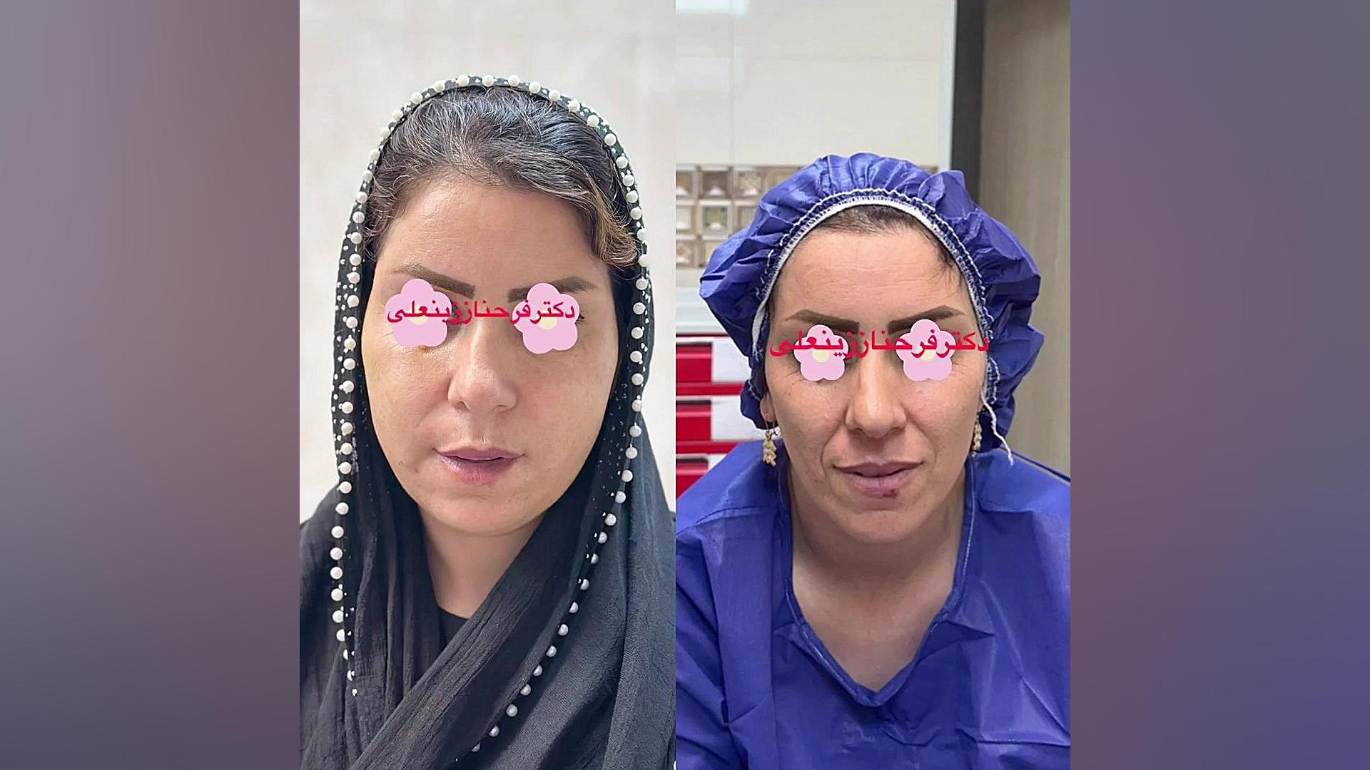 نتیجه تزریق چربی به خط خنده و اطراف دهان برای جوانسازی و زیبایی دائمی صورت دکتر فرحناز زینعلی - متخصص پوست، مو، زیبایی زنجان