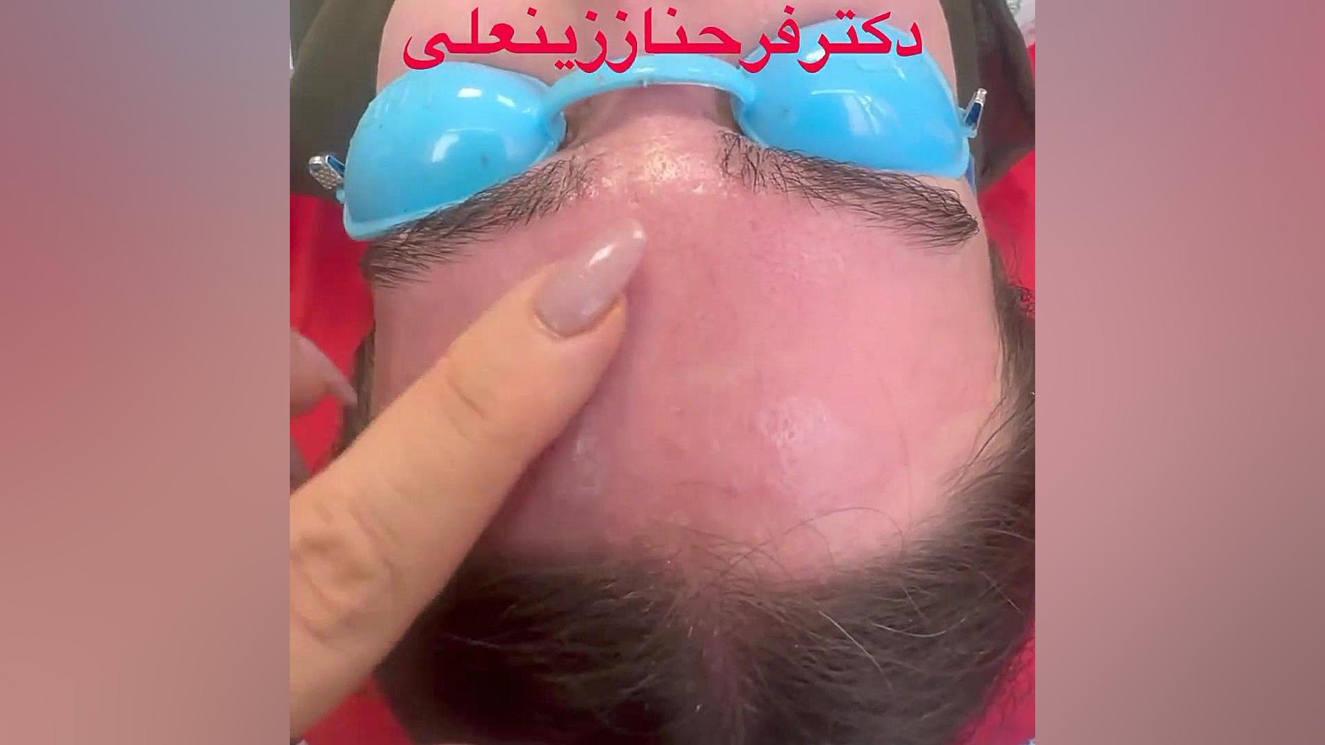 نتیجه عالی بوتاکس پیشانی و دور چشم بعد از بیست روز دکتر فرحناز زینعلی - متخصص پوست، مو، زیبایی زنجان