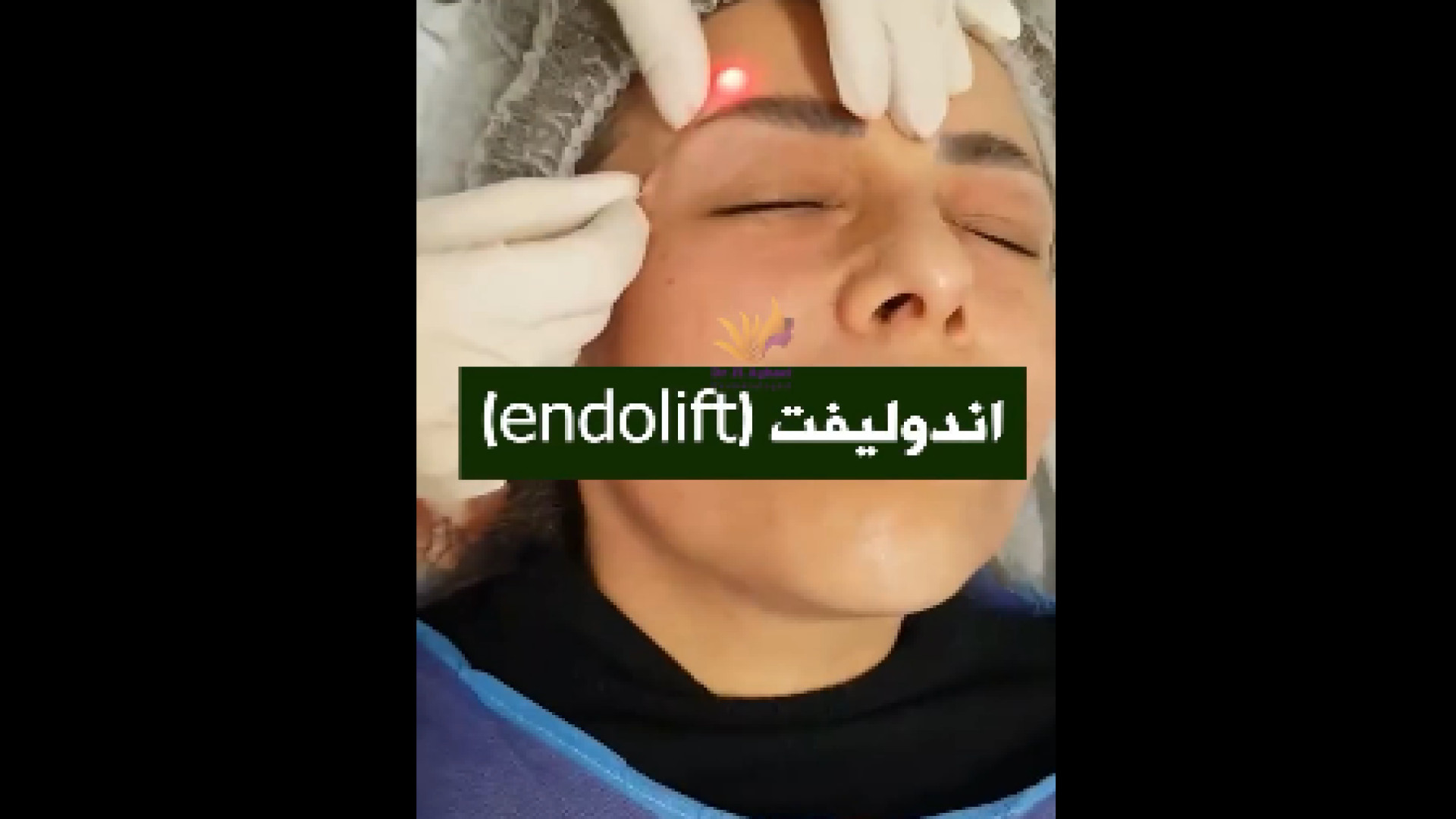 درمان چین و چروک با اندولیفت دکتر حمیده آقایی