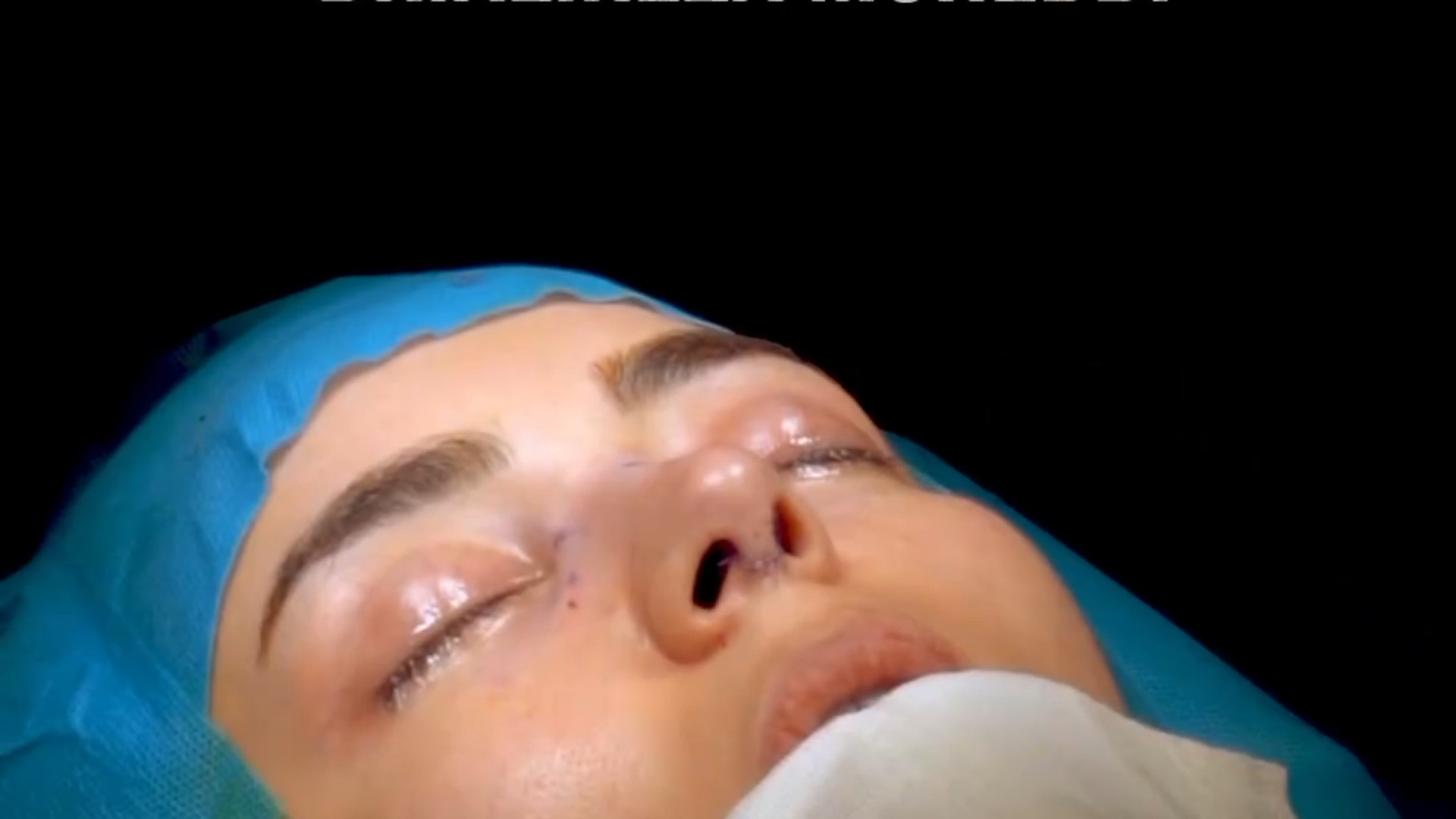 اصلاح انحراف شدید بینی توسط دکتر علیرضا محبی