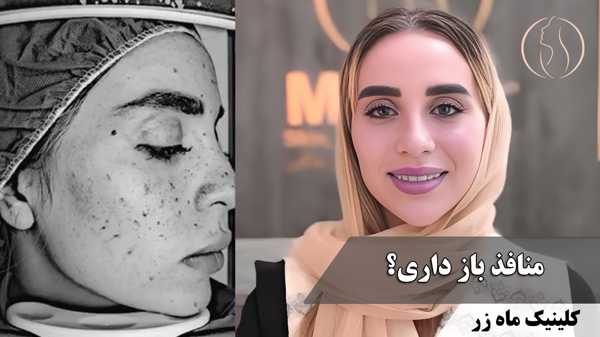 میخوای از جای جوشات خلاص بشی؟! ( کلینیک زیبایی ماه زر ) رزولین