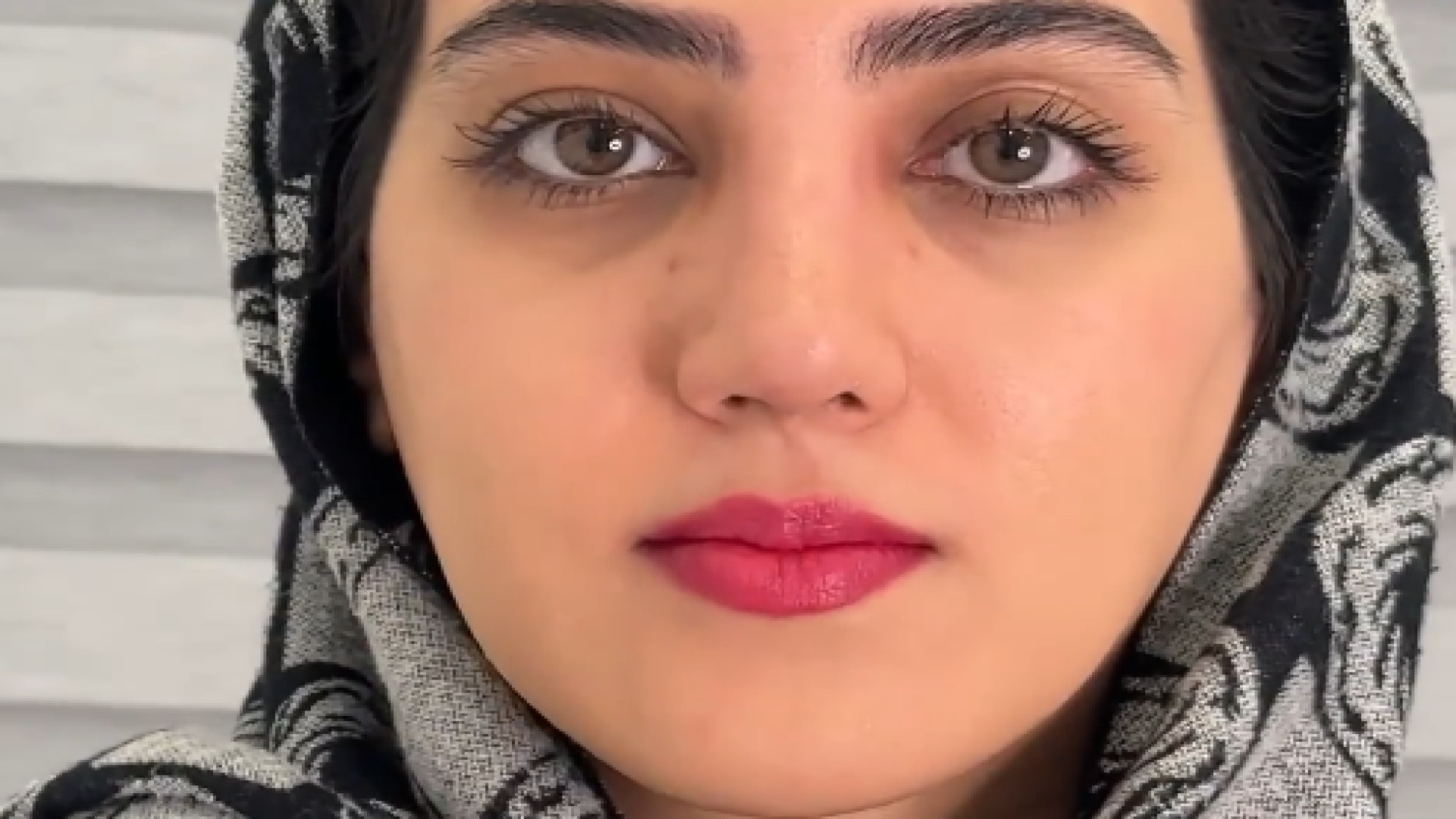 بینی غضروفی استخوانی با انحراف بارز دکتر محمد مجیدی - جراحی بینی به سبک طبیعی شیک
