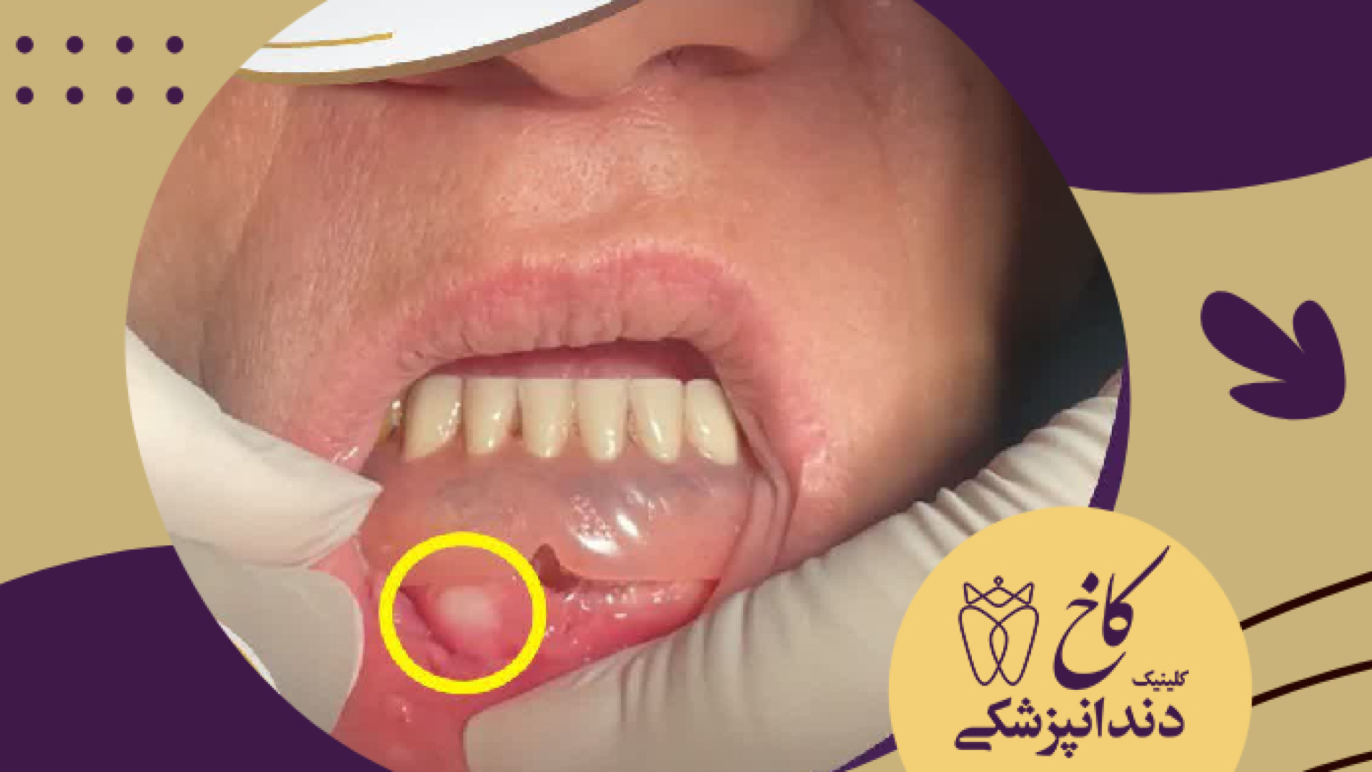 دندان مصنوعی و سرطان دهان کلینیک دندانپزشکی کاخ