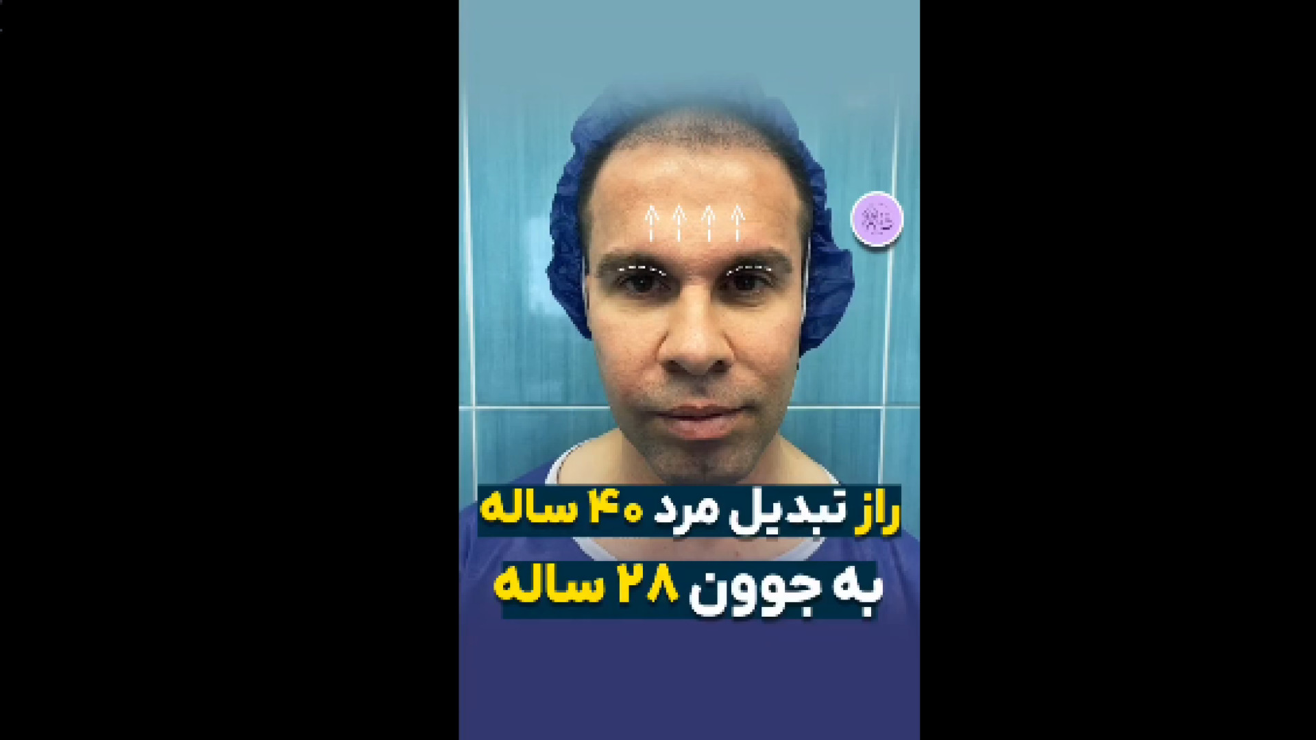 لیفت ابرو و جراحی پلک بیماری سندروم آلاژیل