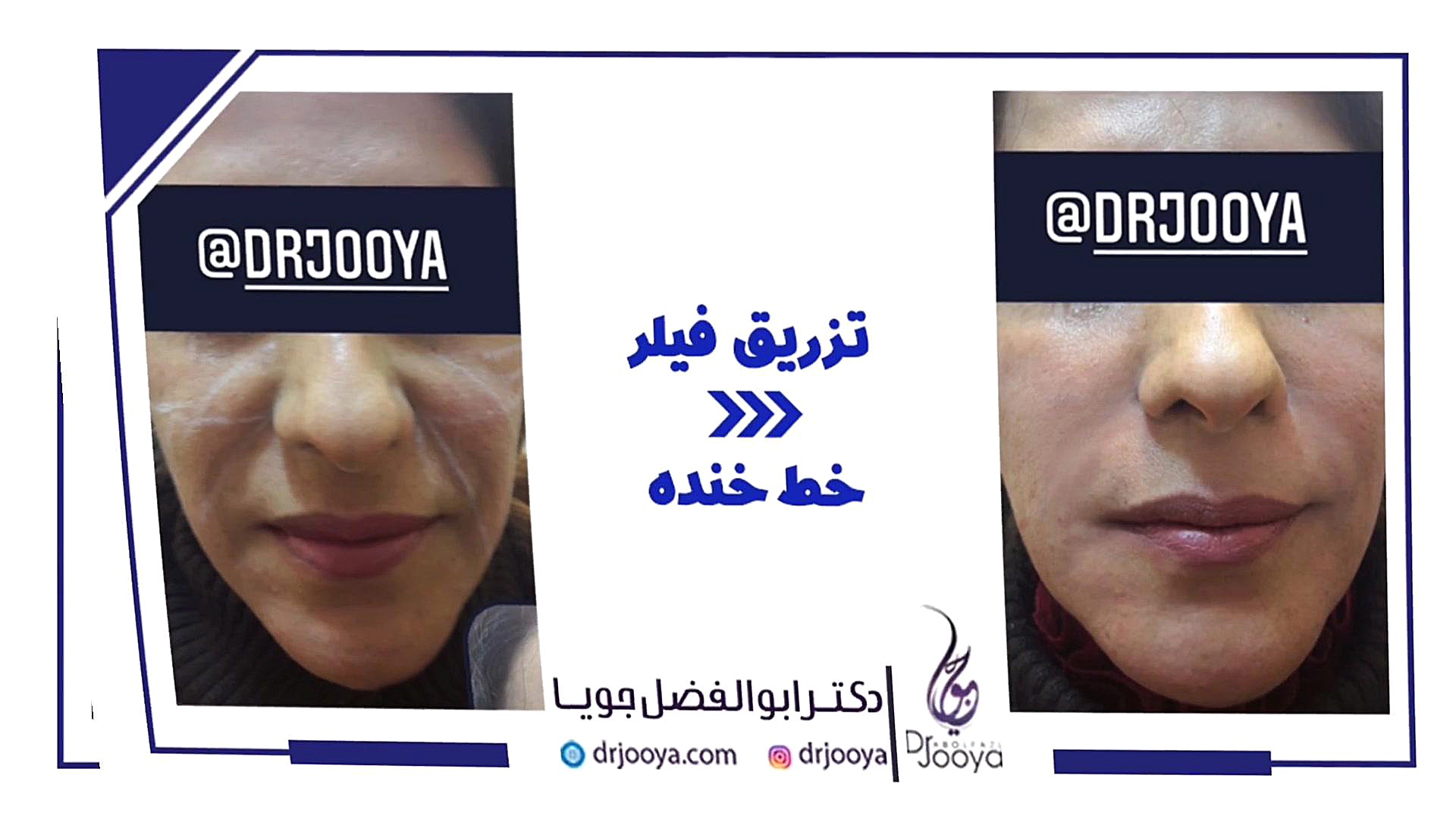 نمونه تزریق فیلر خط خنده (3) | بهترین متخصص زیبایی اصفهان دکتر ابوالفضل جویا