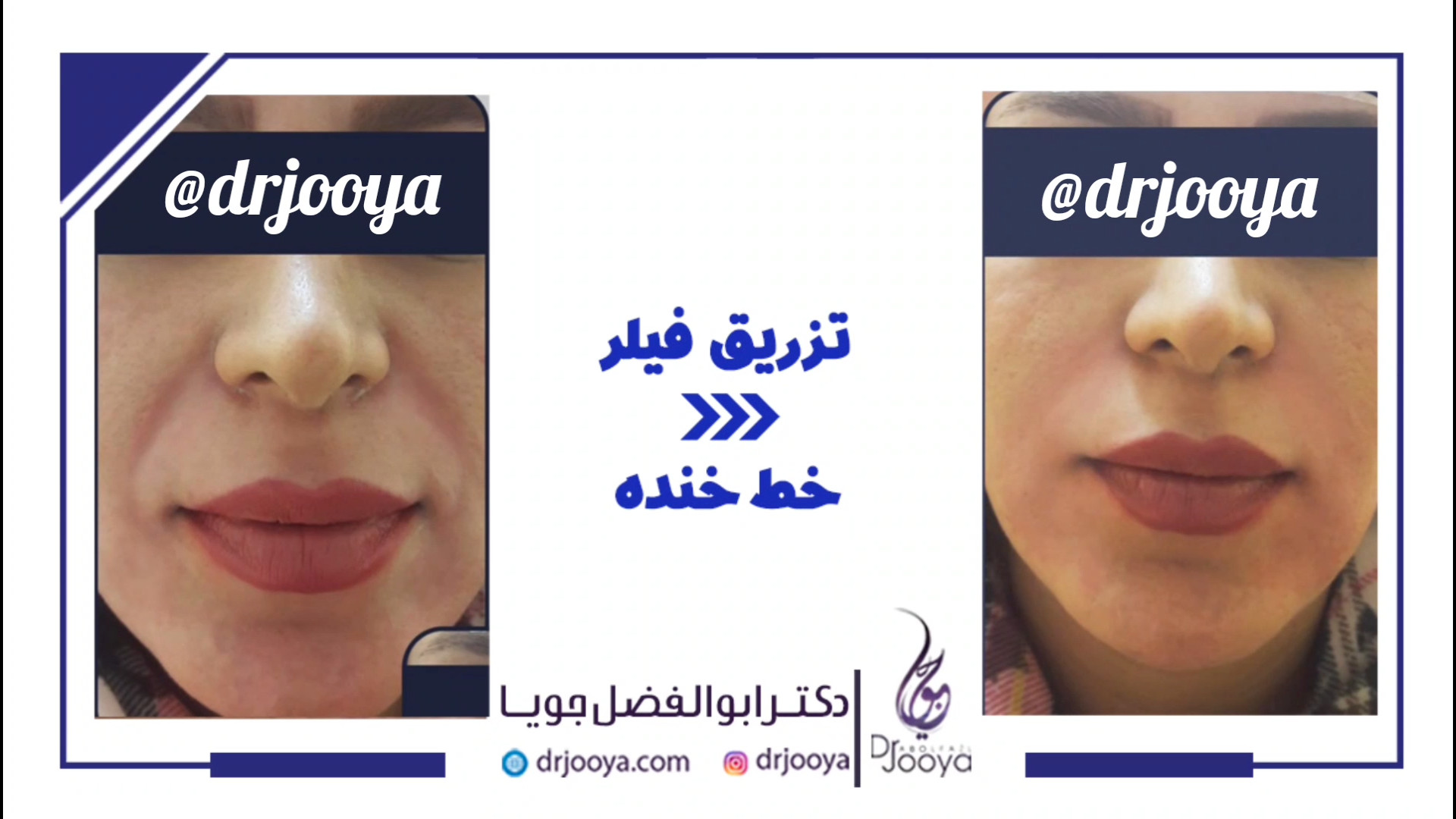 تزریق فیلر خط خنده (4) | بهترین متخصص پوست اصفهان دکتر ابوالفضل جویا