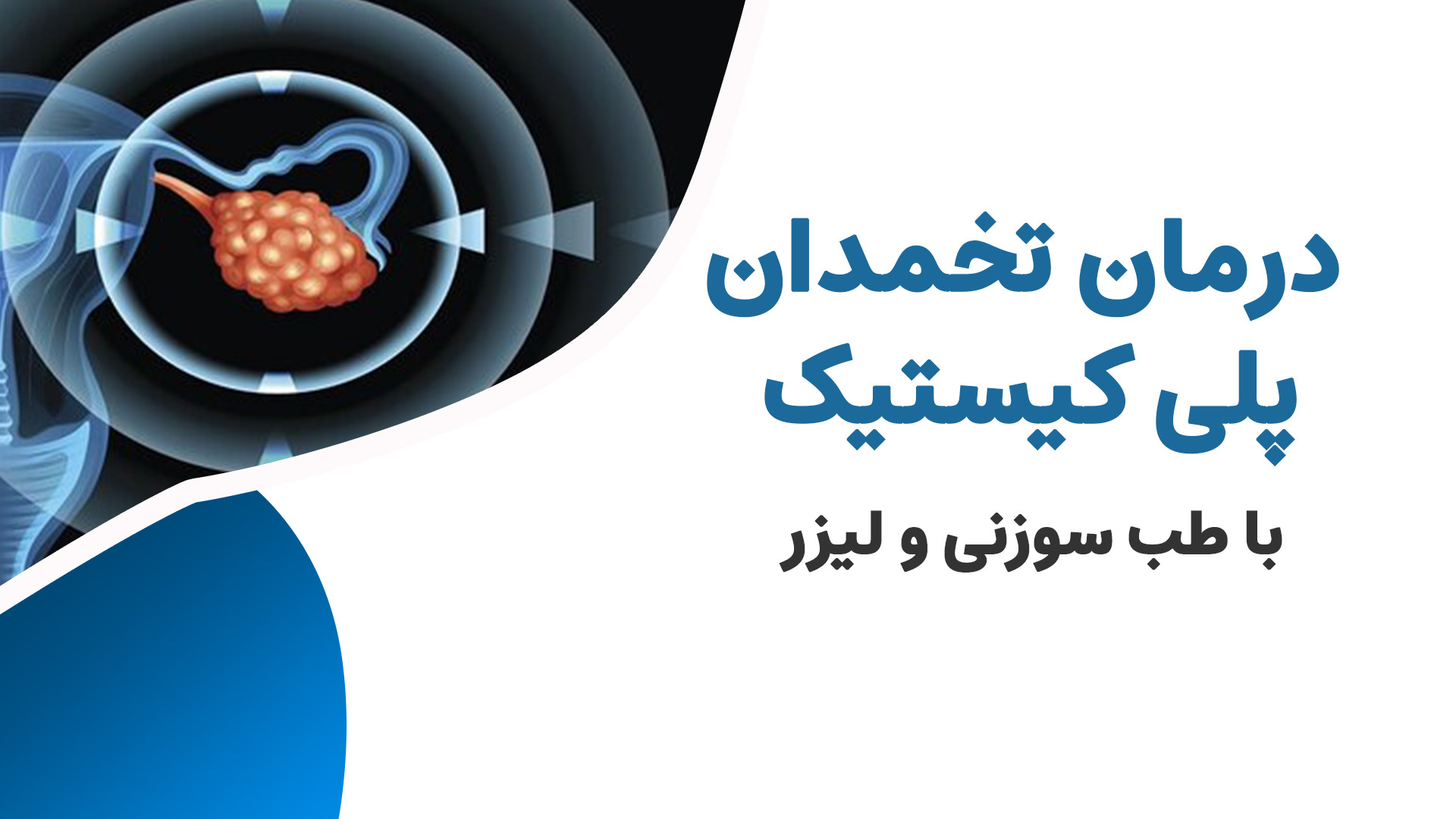 درمان سندرم تخمدان پلی کیستیک (PCOs) با طب سوزنی جنیفر لوپز