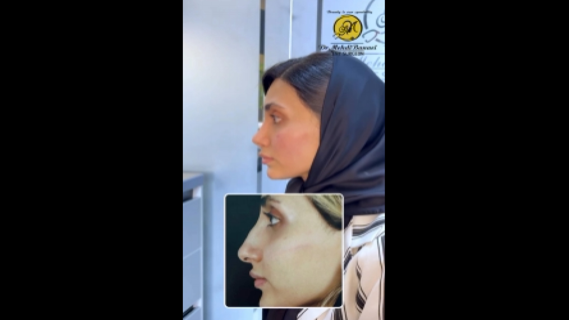 تغییر بعد از عمل بینی یعنی این