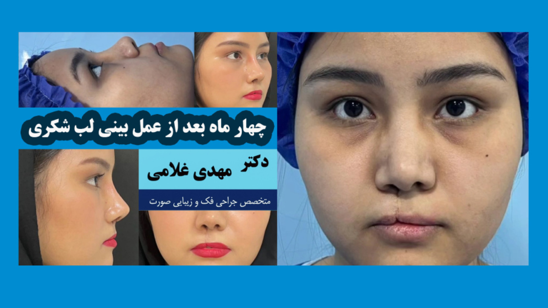 چهار ماه بعد از جراحی بینی لب شکری با دکتر مهدی غلامی دکتر مهدی غلامی