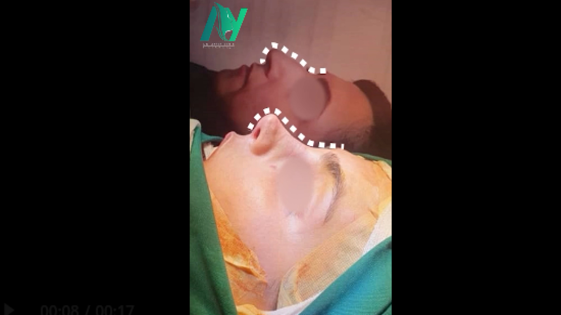 جراحی زیبایی بینی به روش بسته دکتر محمودرضا اصحاب یمین - فوق تخصص پلاستیک