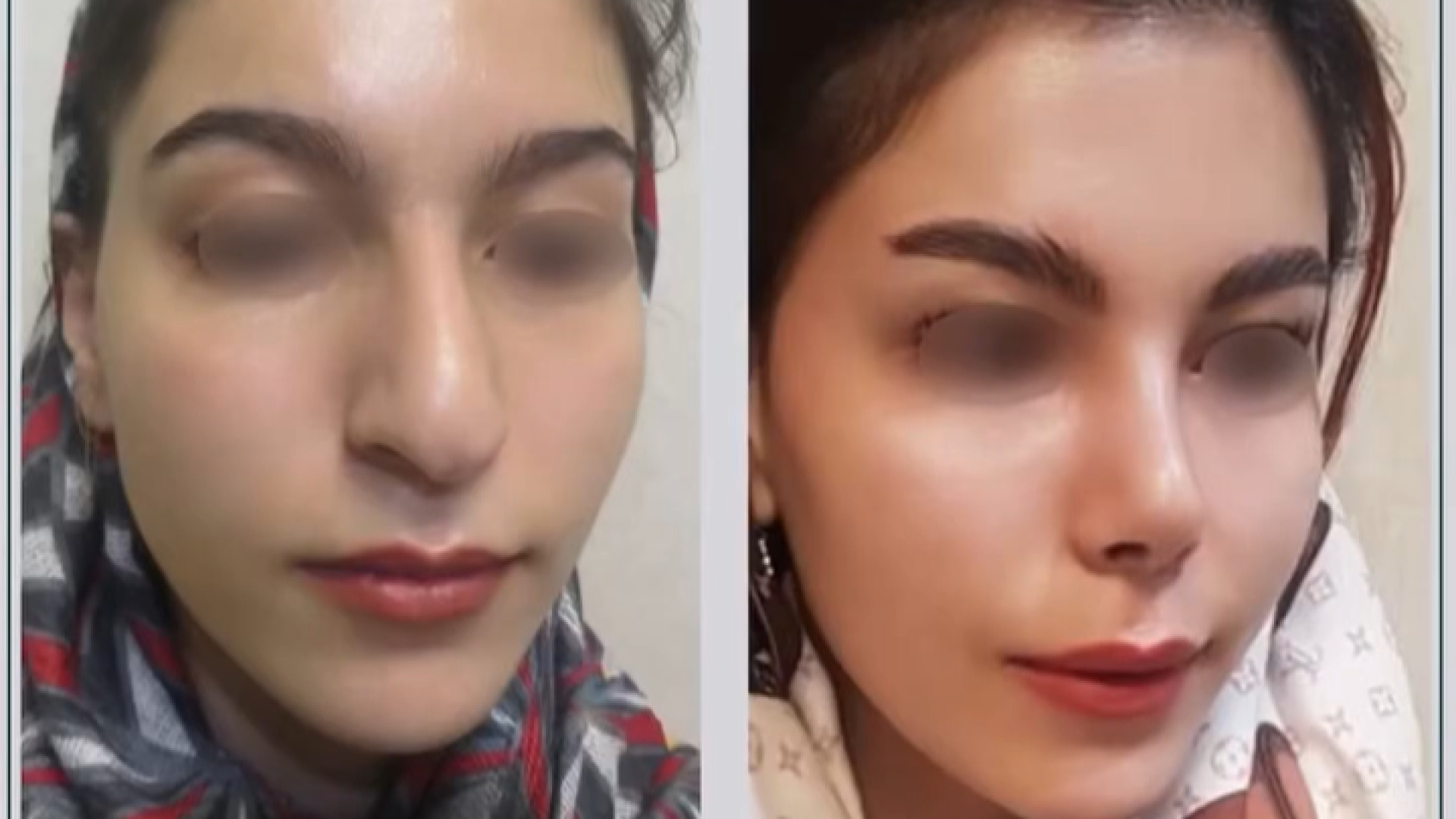 قبل و بعد رینوپلاستی دکتر محمودرضا اصحاب یمین - فوق تخصص پلاستیک