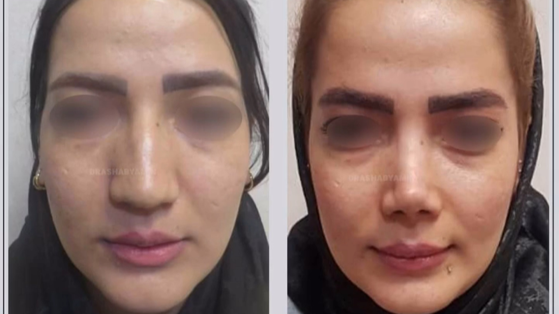 نتیجه عمل بینی دکتر محمودرضا اصحاب یمین - فوق تخصص پلاستیک