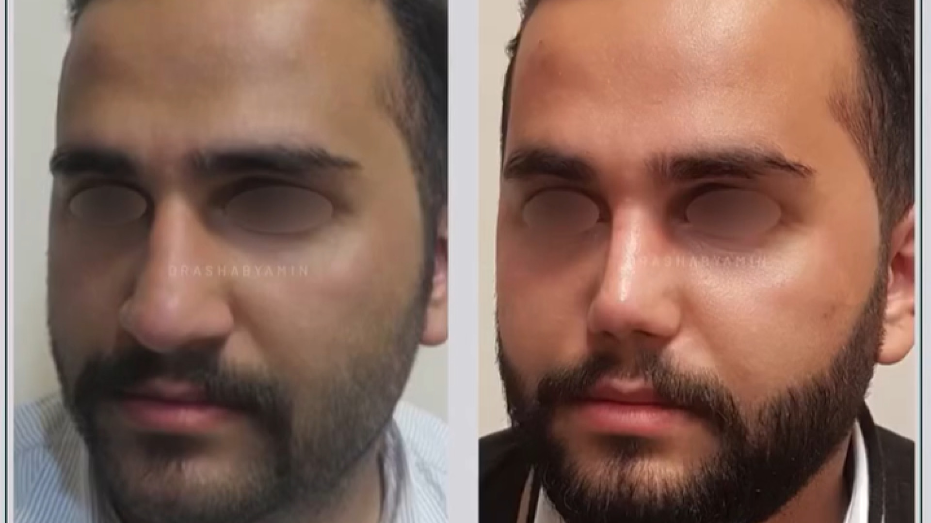 نتیجه رینوپلاستی دکتر محمودرضا اصحاب یمین - فوق تخصص پلاستیک