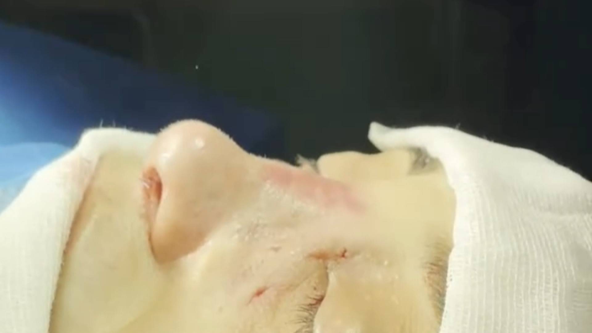رینوپلاستی ثانویه دکتر حمید رضا فتحی فوق تخصص جراحی پلاستیک