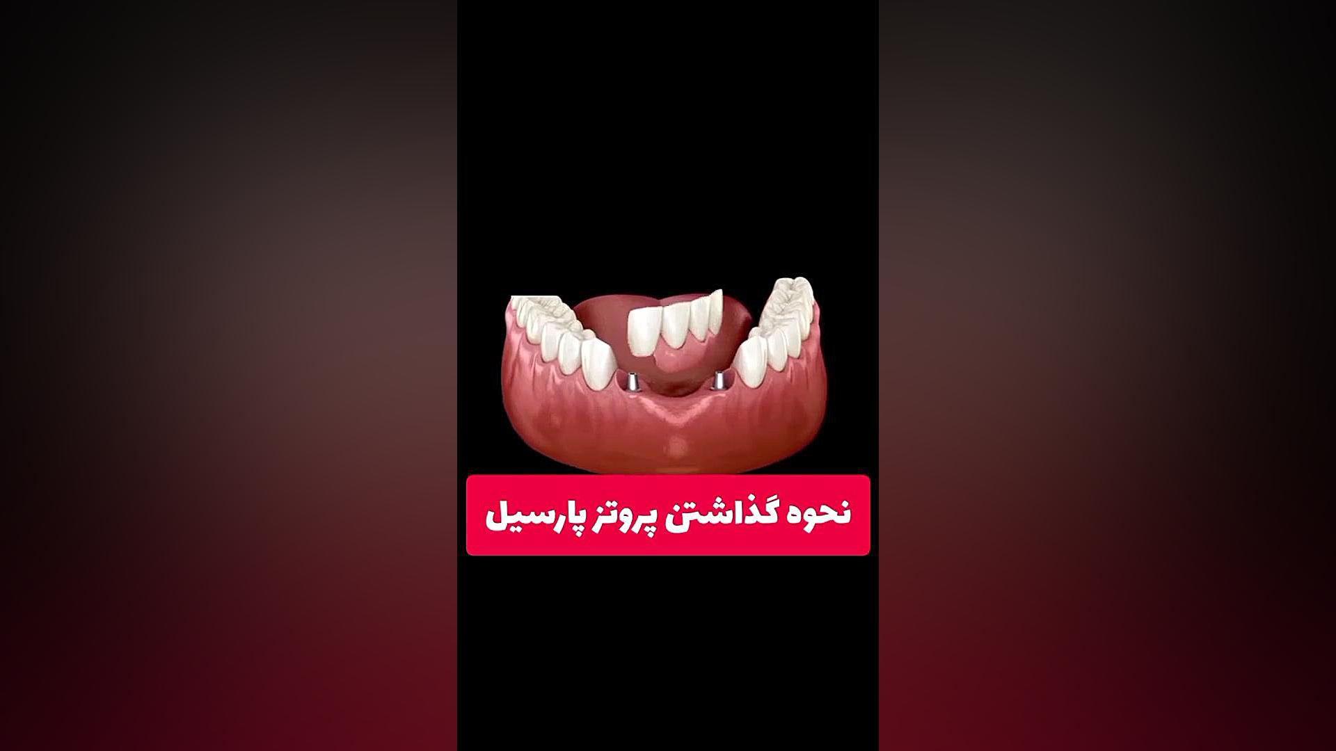 فیلم نحوه گذاشتن دندان مصنوعی پارسیل فک پایین TWA