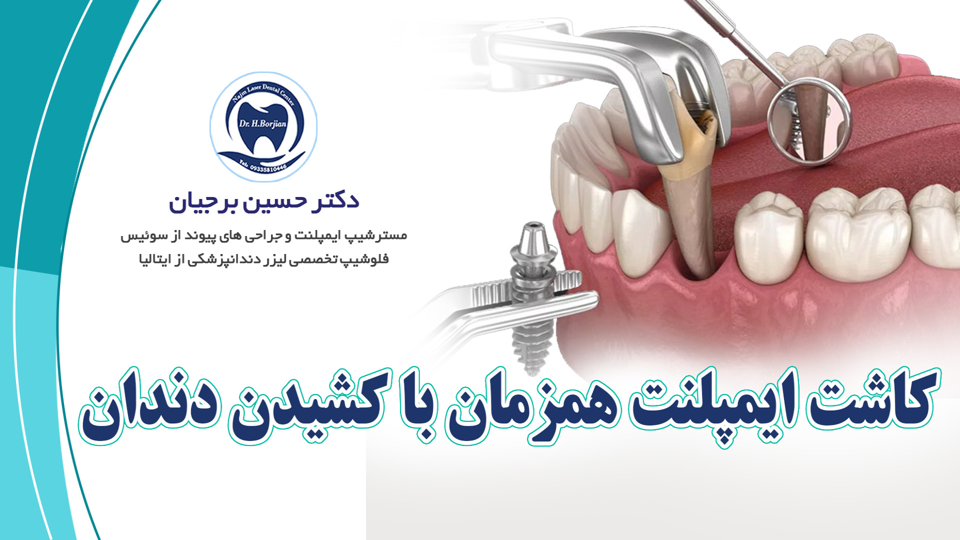 آیا کاشت ایمپلنت همزمان با کشیدن دندان امکانپذیر است؟| متخصص ایمپلنت اصفهان ANA