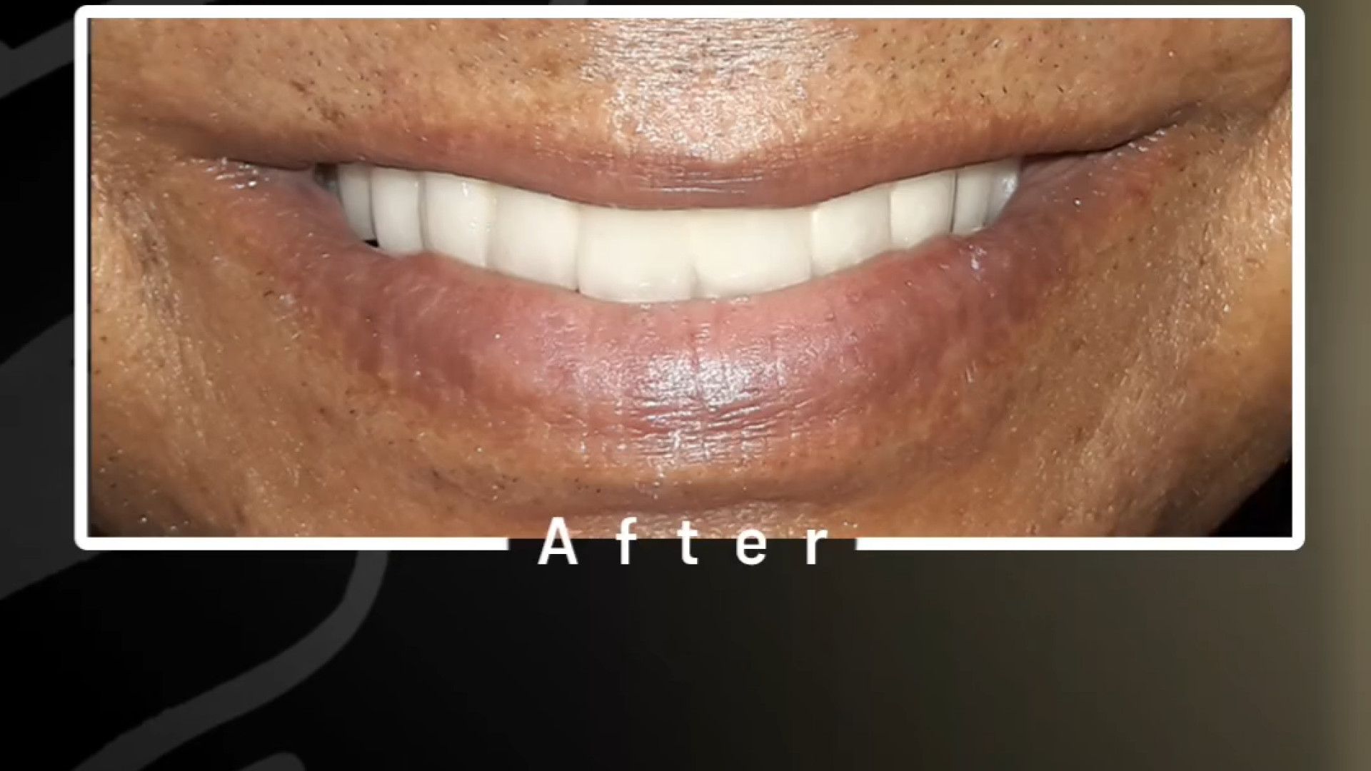 ایمپلنت طرح لبخند دکتر علی قمری - متخصص جراحی لثه و ایمپلنت