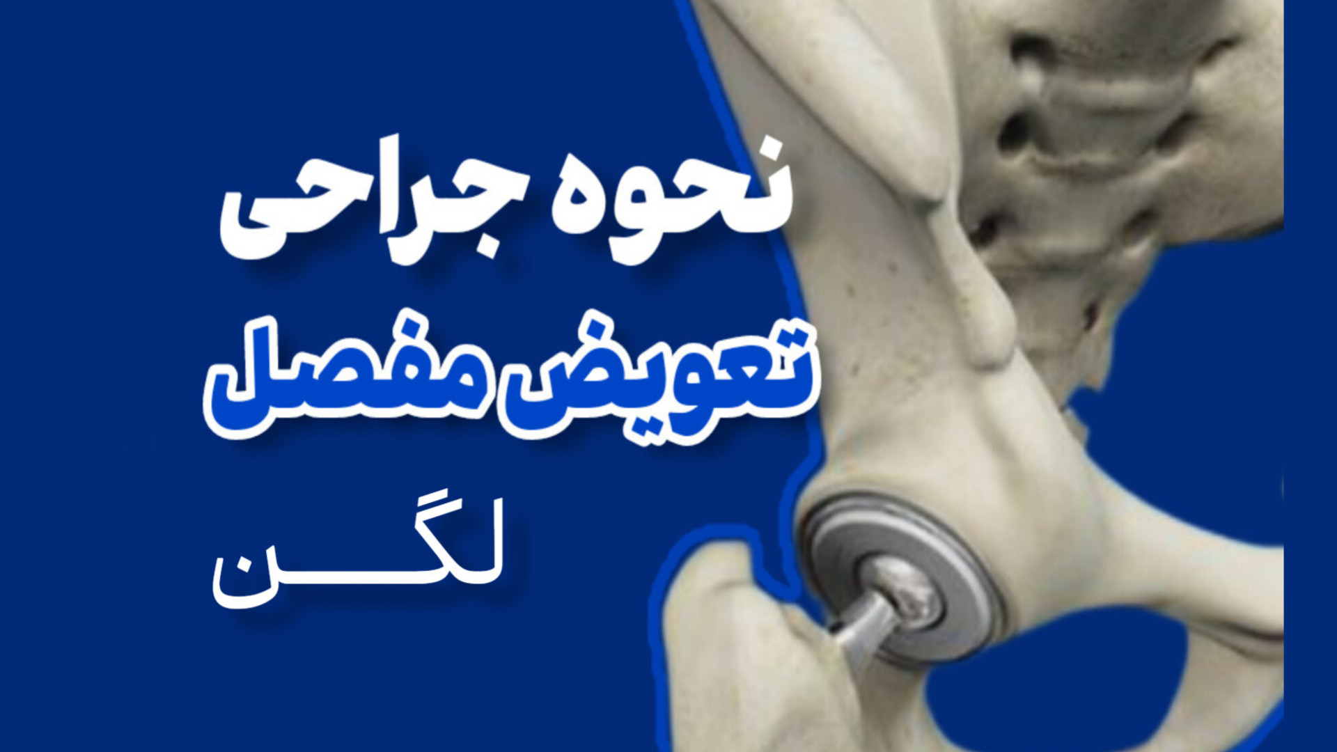 نحوه تعویض مفصل لگن دکتر محمود جعفر بیگلو