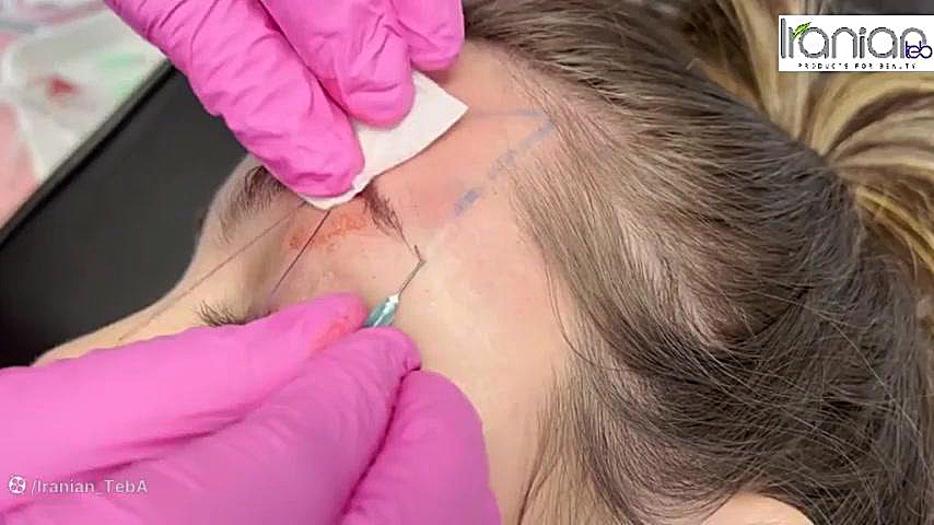 لیفت ابرو با نخ COG 19G-60 برند TRQ بیماری پیرفیریک نوروپاتی