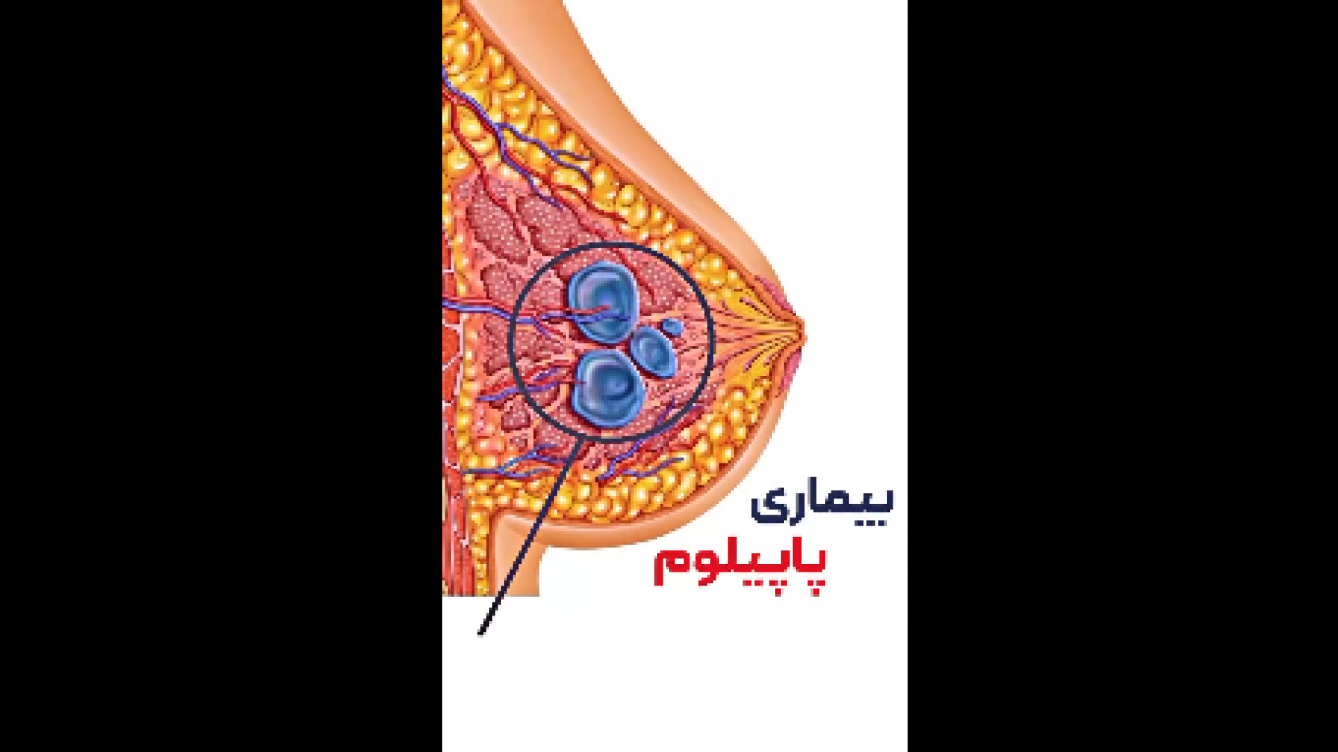 با بیماری پاپیلوم داخل مجرا آشنا شوید کریستیانو رونالدو
